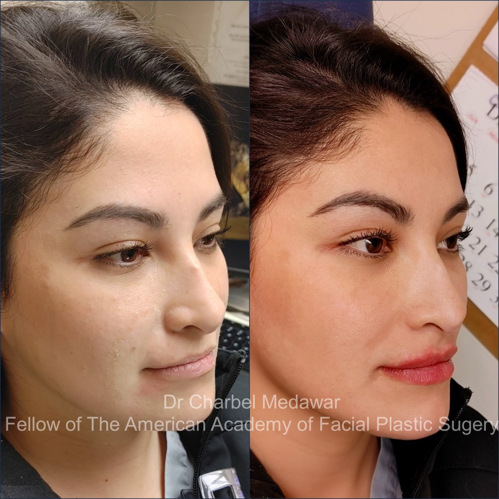 lip fillers beirut lebanon plastic surgery style beauty clinic dr charbel medawar  facial plastic surgeon