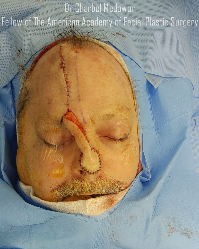 paramedian forehead flap skin cancer reconstruction beirut lebanon dr charbel medawar style beauty clinic dubai