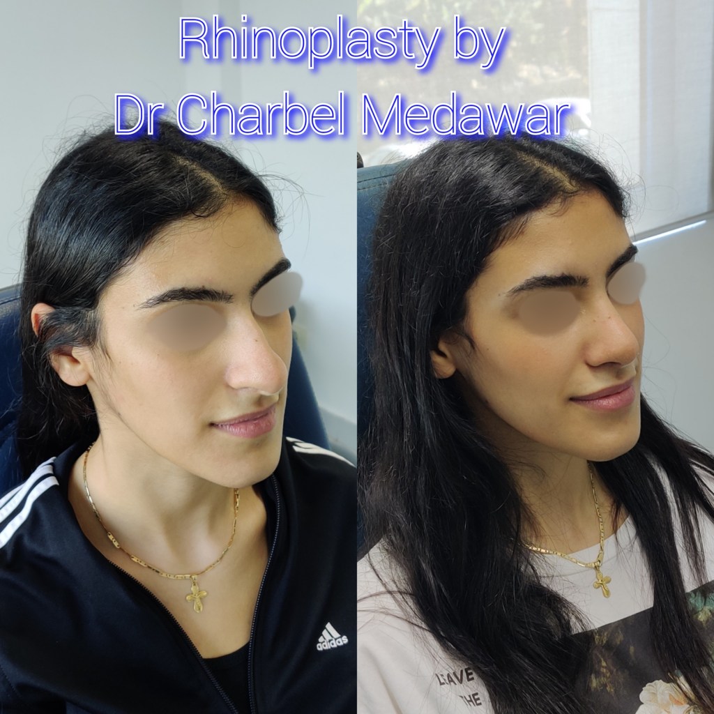 #rhinoplasty #nosejob #dr #charbel #medawar #facial #plastic #surgeon #beirut #lebanon #surgery #style #beauty #clinc #dubai #middle #east