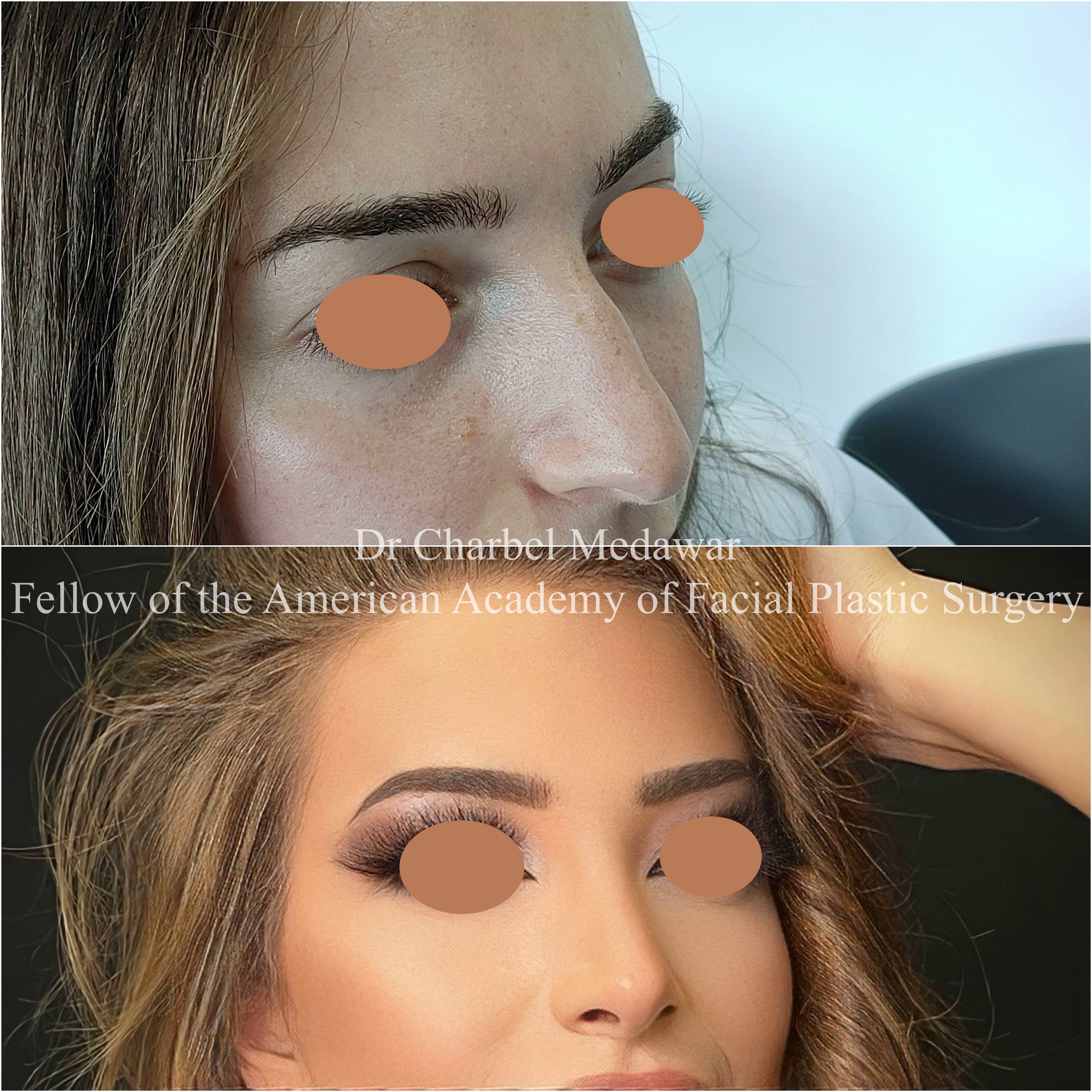 #rhinoplasty #nosejob #dr #charbel #medawar #facial #plastic #surgeon #beirut #lebanon #surgery #style #beauty #clinc #dubai #middle #east