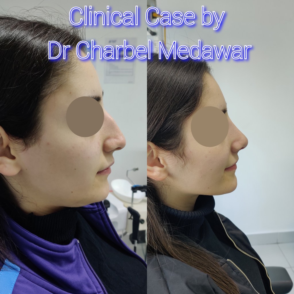 #rhinoplasty #nosejob #dr #charbel #medawar #facial #plastic #surgeon #beirut #lebanon #surgery #style #beauty #clinc #dubai #middle #east