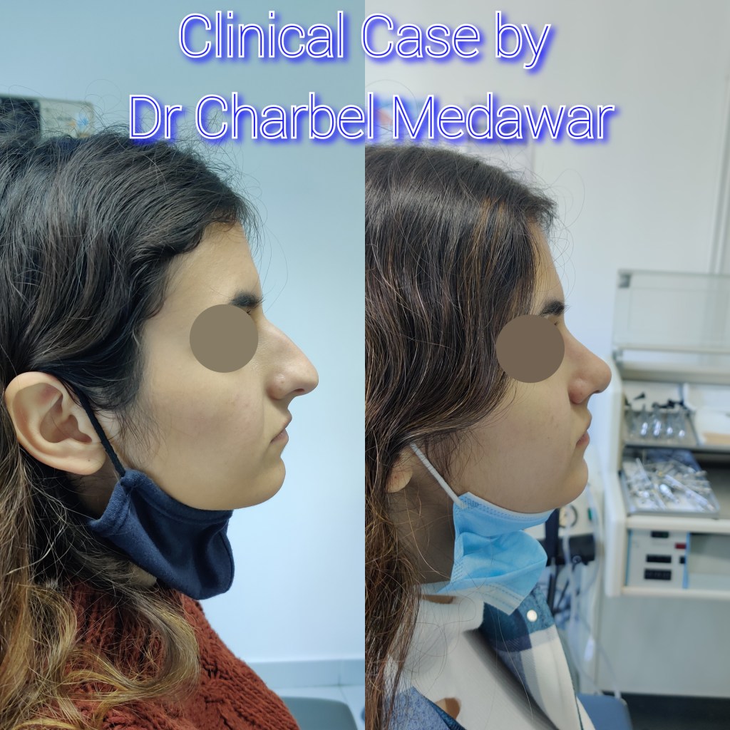 #rhinoplasty #nosejob #dr #charbel #medawar #facial #plastic #surgeon #beirut #lebanon #surgery #style #beauty #clinc #dubai #middle #east
