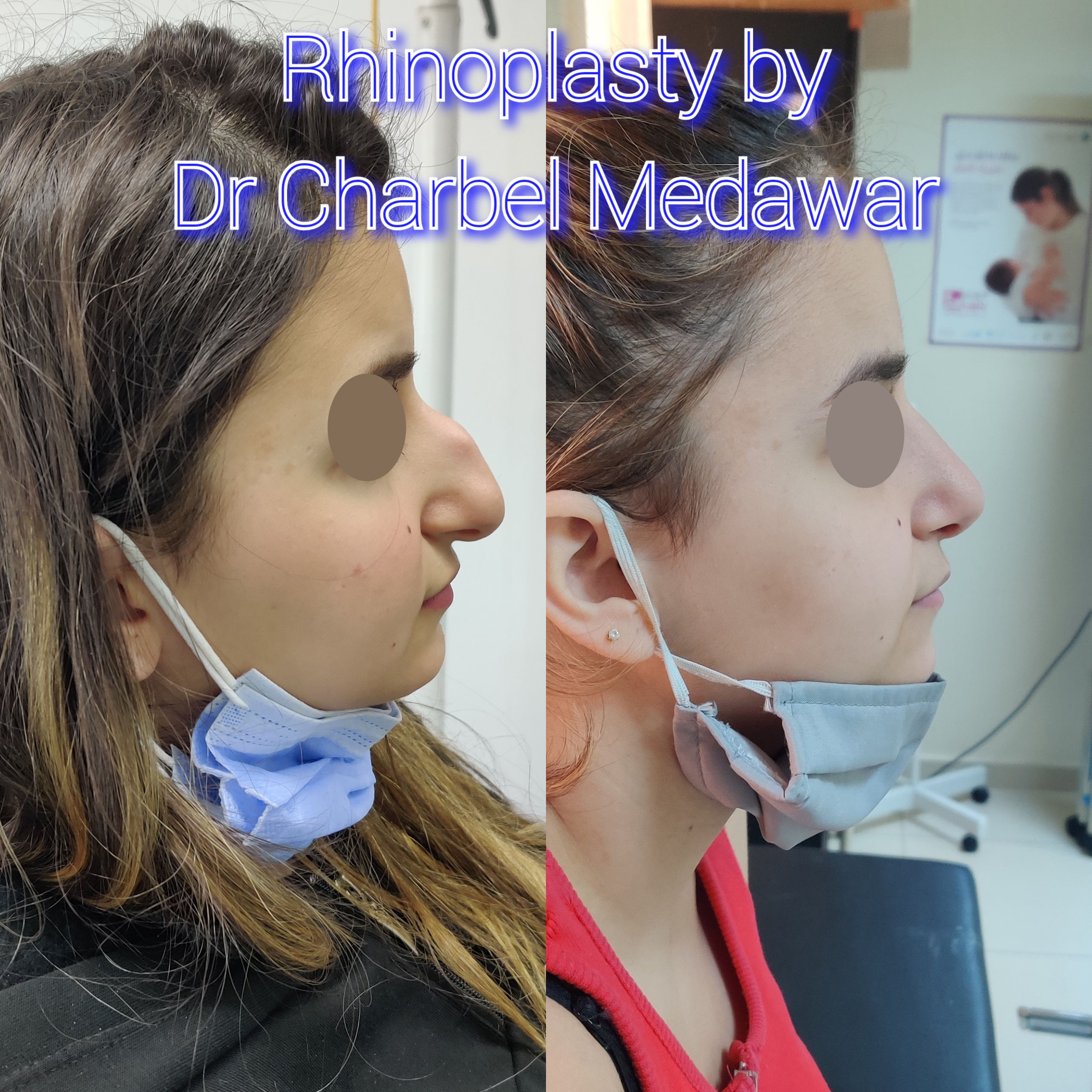 #rhinoplasty #nosejob #dr #charbel #medawar #facial #plastic #surgeon #beirut #lebanon #surgery #style #beauty #clinc #dubai #middle #east