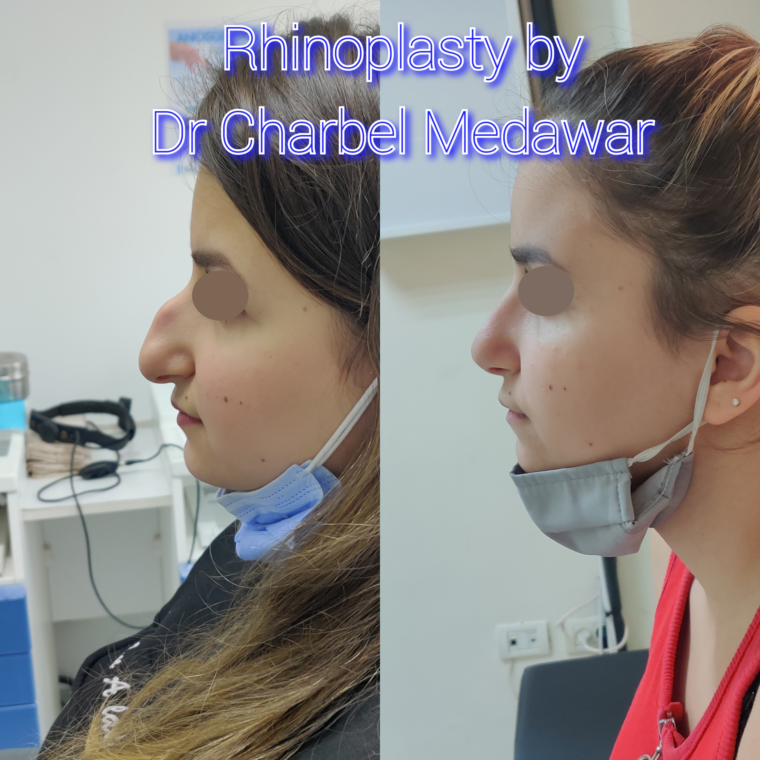 #rhinoplasty #nosejob #dr #charbel #medawar #facial #plastic #surgeon #beirut #lebanon #surgery #style #beauty #clinc #dubai #middle #east