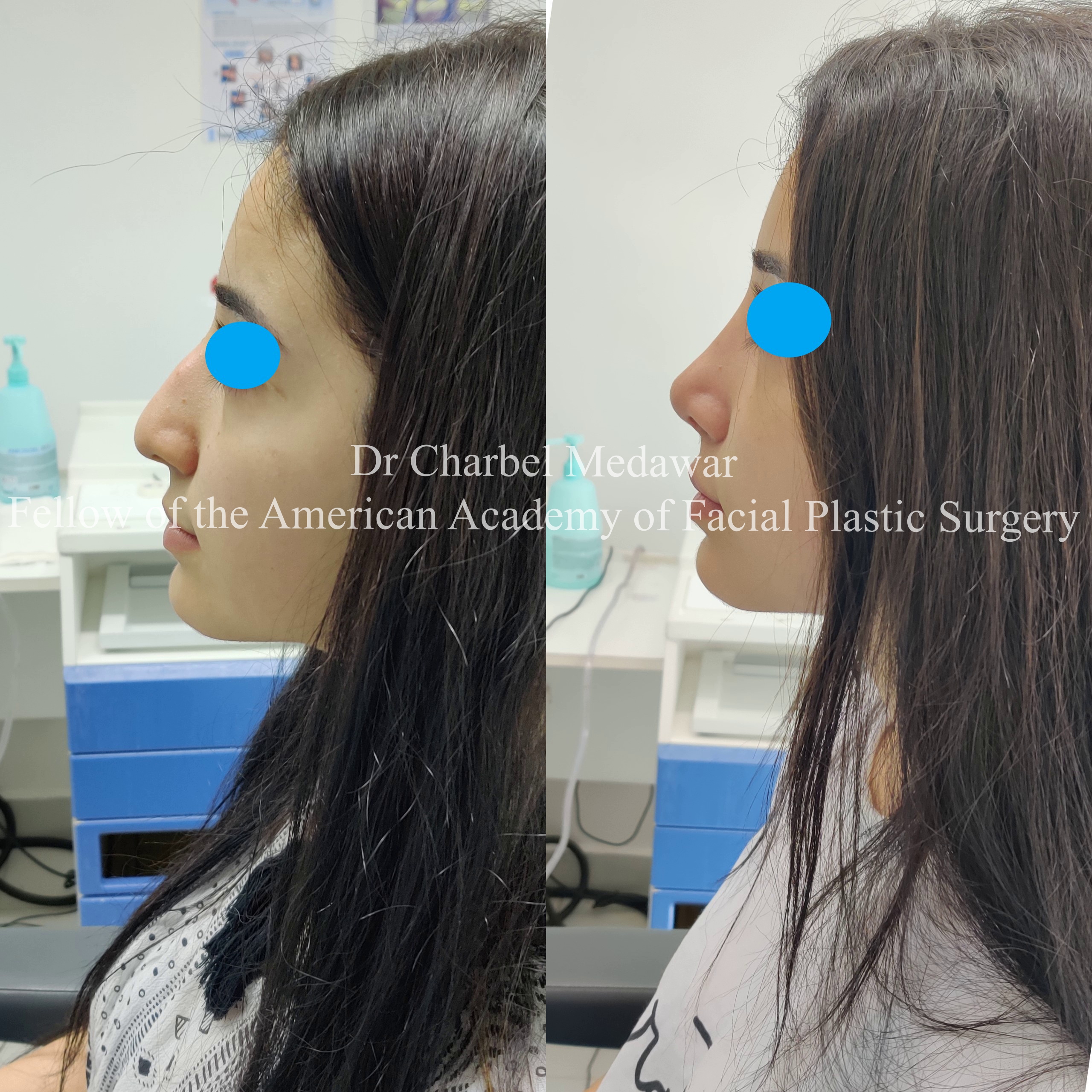 #rhinoplasty #nosejob #dr #charbel #medawar #facial #plastic #surgeon #beirut #lebanon #surgery #style #beauty #clinc #dubai #middle #east