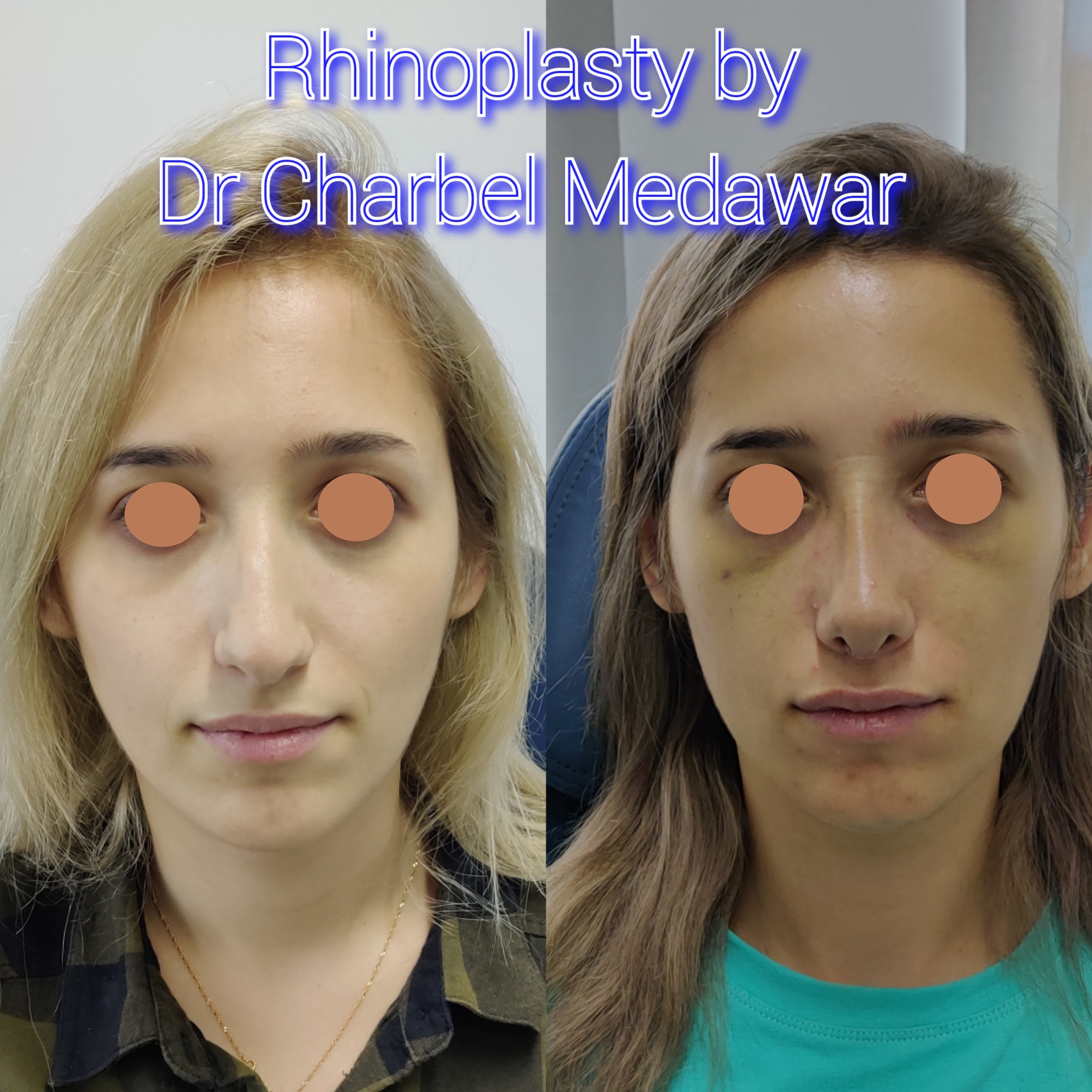 #rhinoplasty #nosejob #dr #charbel #medawar #facial #plastic #surgeon #beirut #lebanon #surgery #style #beauty #clinc #dubai #middle #east