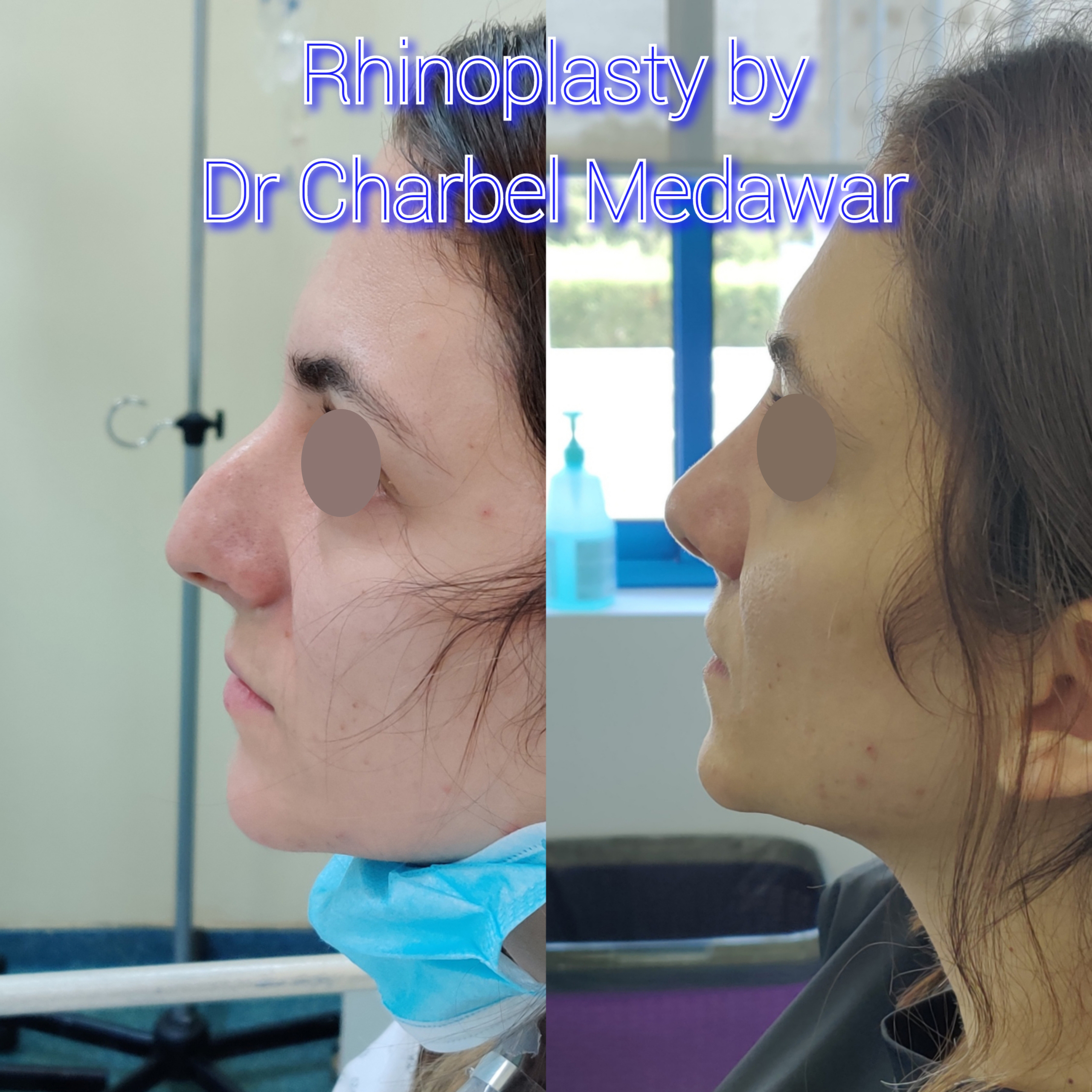 #rhinoplasty #nosejob #dr #charbel #medawar #facial #plastic #surgeon #beirut #lebanon #surgery #style #beauty #clinc #dubai #middle #east