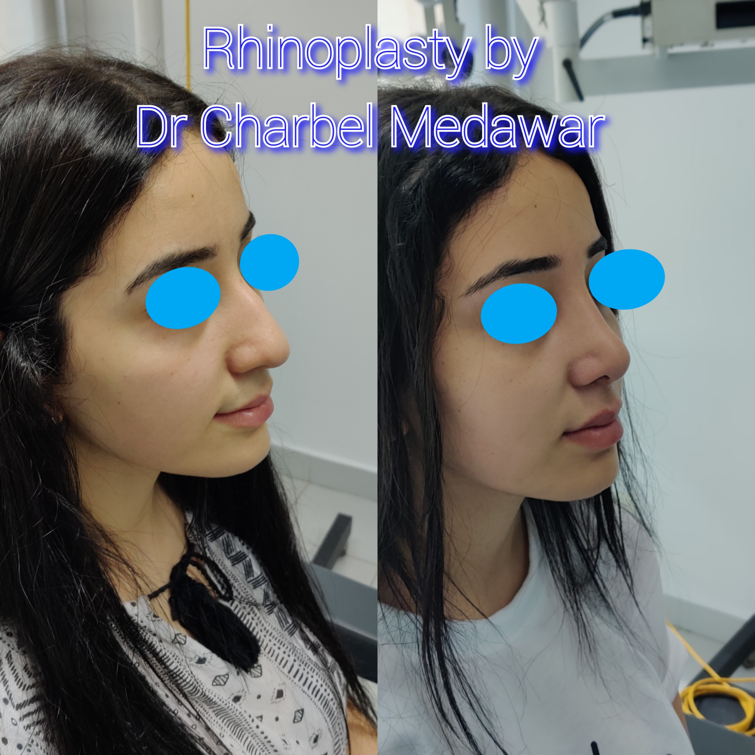 #rhinoplasty #nosejob #dr #charbel #medawar #facial #plastic #surgeon #beirut #lebanon #surgery #style #beauty #clinc #dubai #middle #east