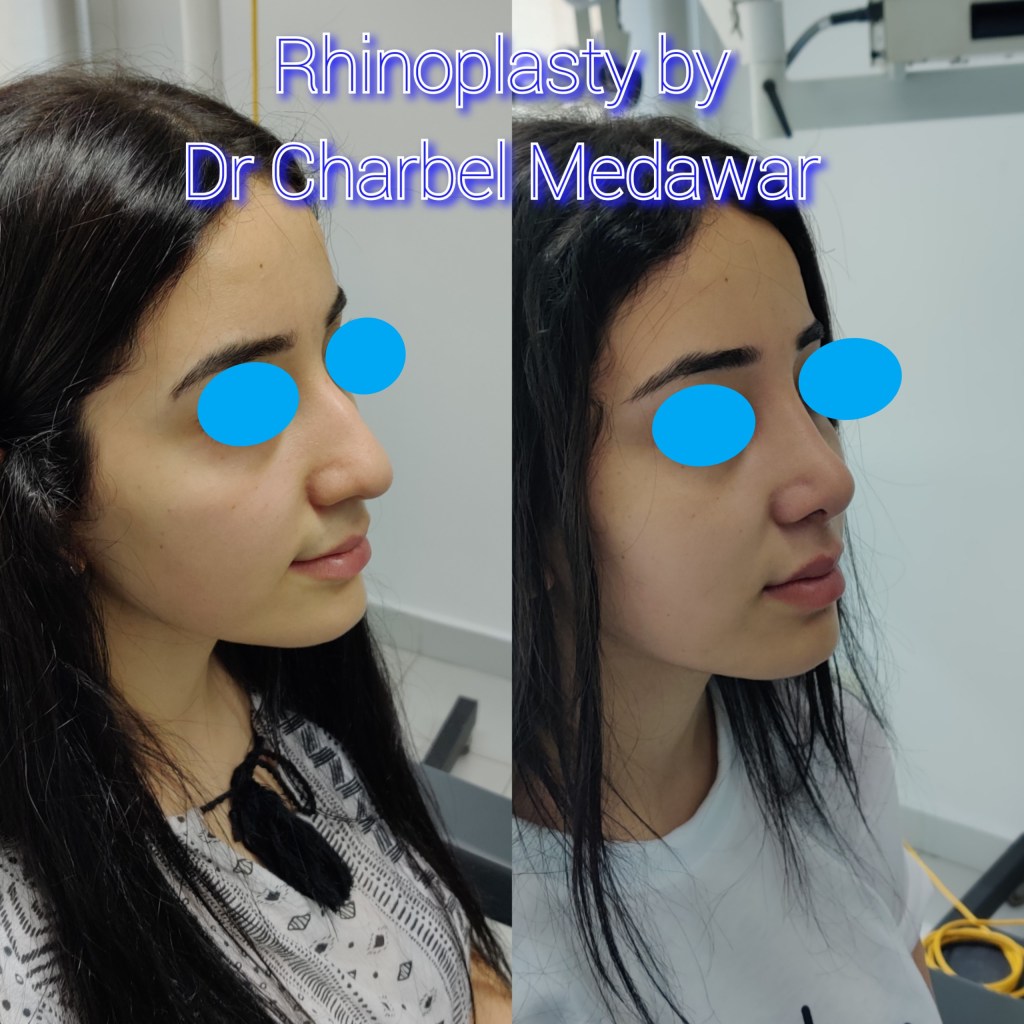 #rhinoplasty #nosejob #dr #charbel #medawar #facial #plastic #surgeon #beirut #lebanon #surgery #style #beauty #clinc #dubai #middle #east