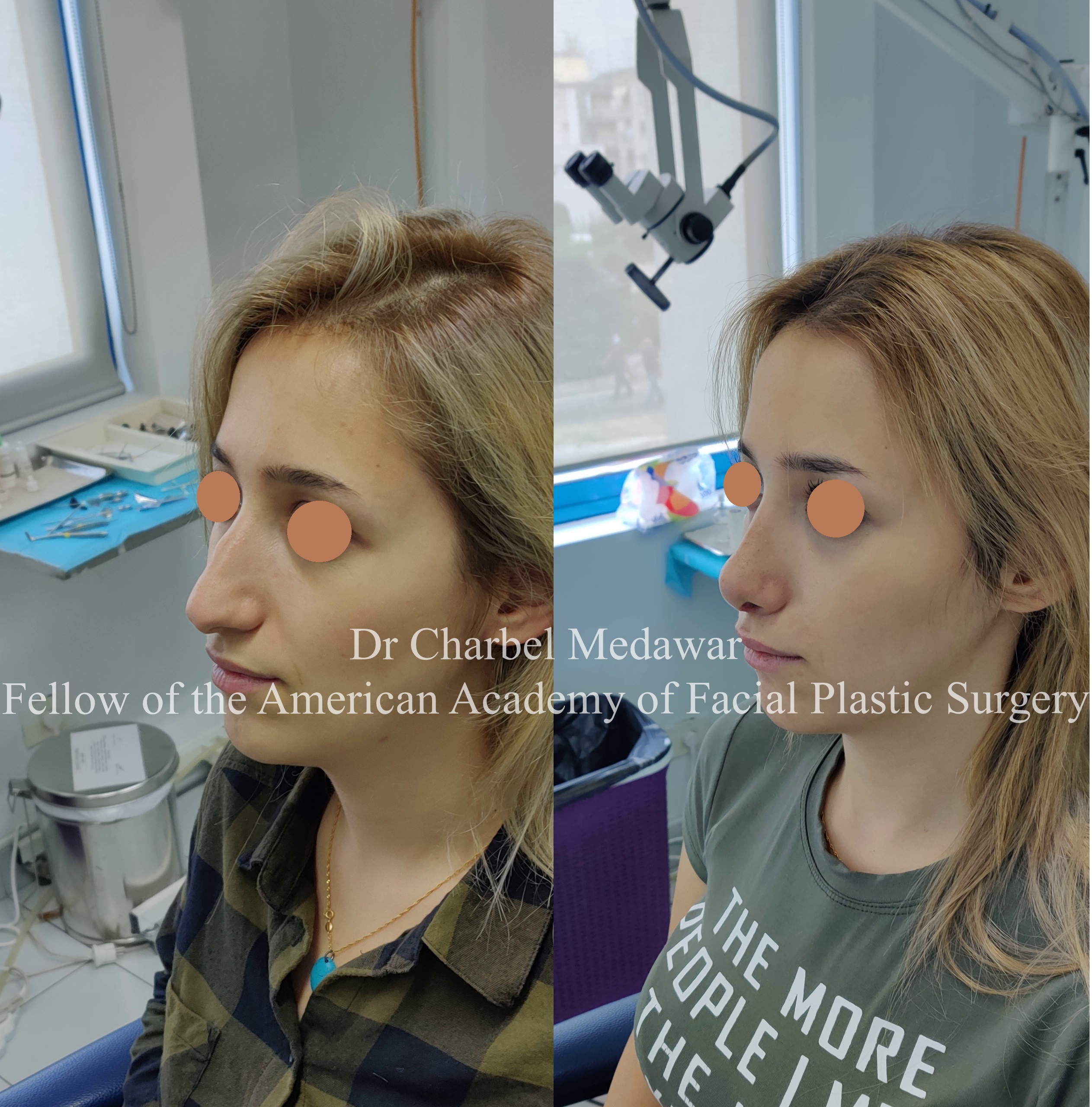 #rhinoplasty #nosejob #dr #charbel #medawar #facial #plastic #surgeon #beirut #lebanon #surgery #style #beauty #clinc #dubai #middle #east