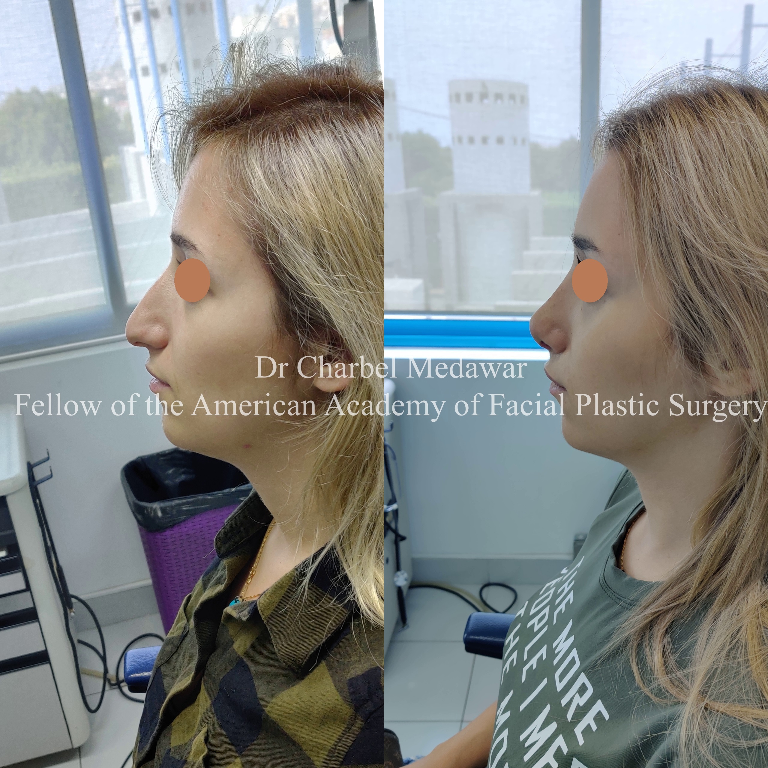 #rhinoplasty #nosejob #dr #charbel #medawar #facial #plastic #surgeon #beirut #lebanon #surgery #style #beauty #clinc #dubai #middle #east
