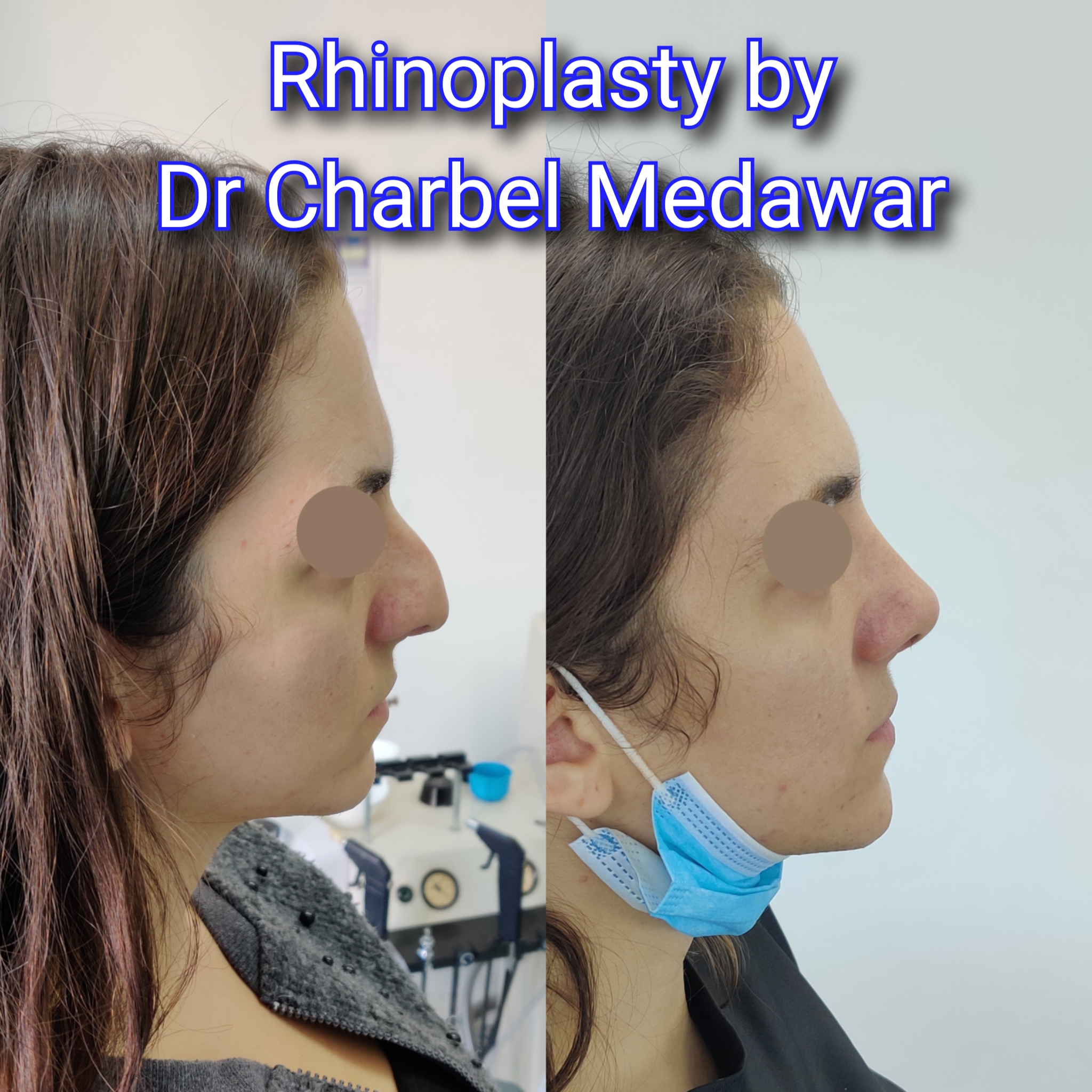 #rhinoplasty #nosejob #dr #charbel #medawar #facial #plastic #surgeon #beirut #lebanon #surgery #style #beauty #clinc #dubai #middle #east