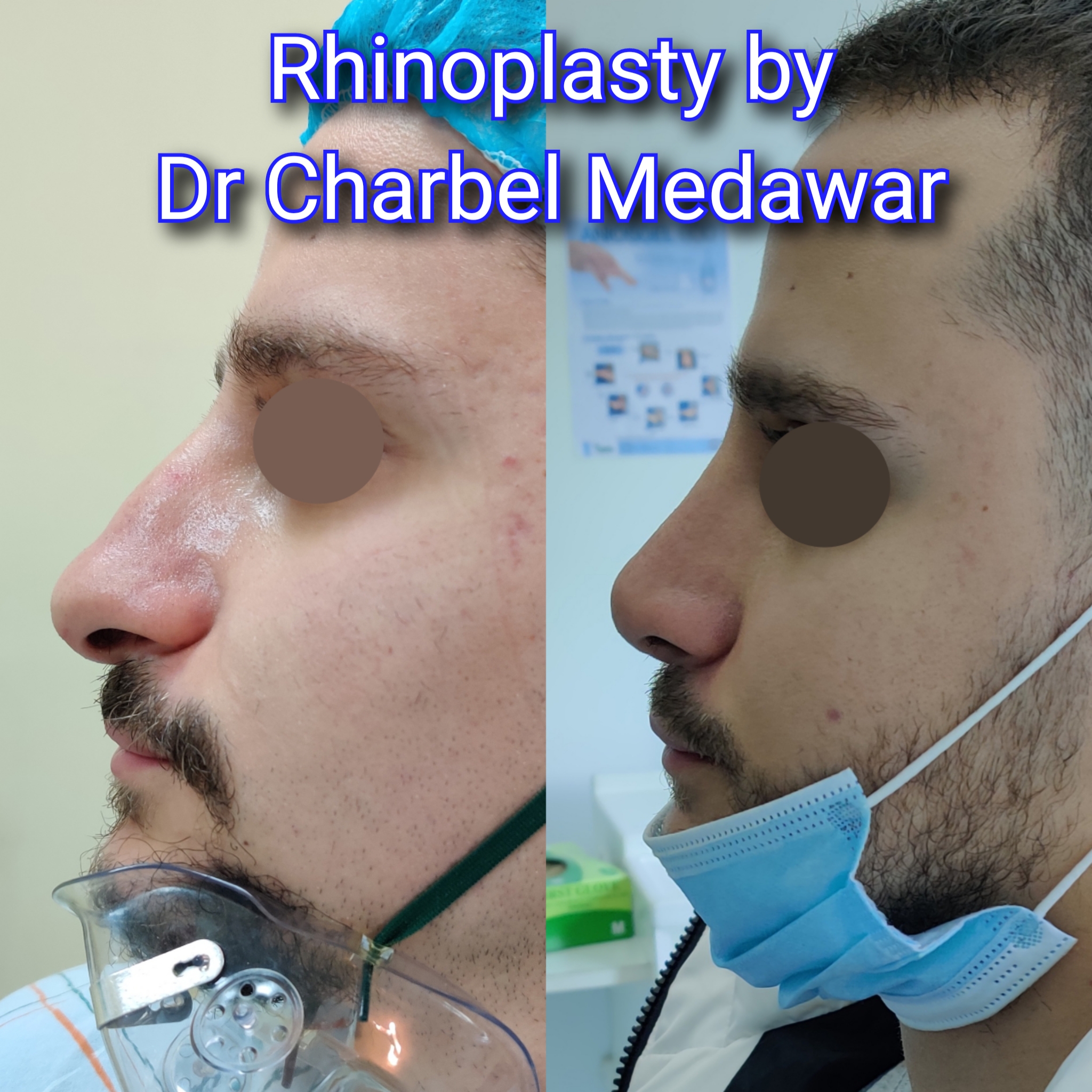 #rhinoplasty #nosejob #dr #charbel #medawar #facial #plastic #surgeon #beirut #lebanon #surgery #style #beauty #clinc #dubai #middle #east