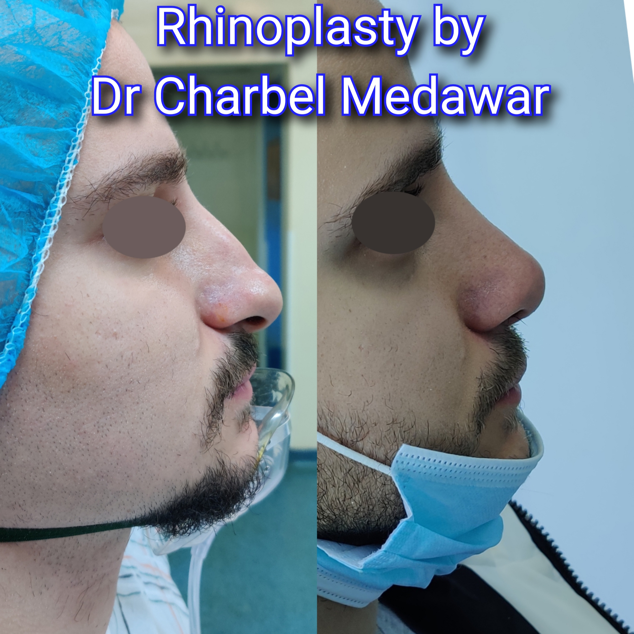 #rhinoplasty #nosejob #dr #charbel #medawar #facial #plastic #surgeon #beirut #lebanon #surgery #style #beauty #clinc #dubai #middle #east
