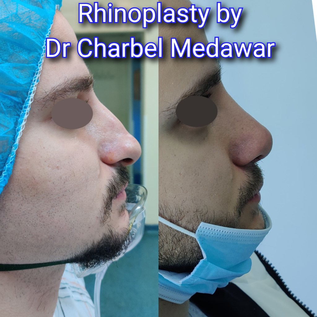 #rhinoplasty #nosejob #dr #charbel #medawar #facial #plastic #surgeon #beirut #lebanon #surgery #style #beauty #clinc #dubai #middle #east