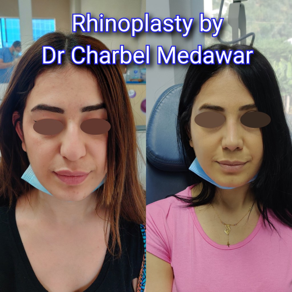 #rhinoplasty #nosejob #dr #charbel #medawar #facial #plastic #surgeon #beirut #lebanon #surgery #style #beauty #clinc #dubai #middle #east