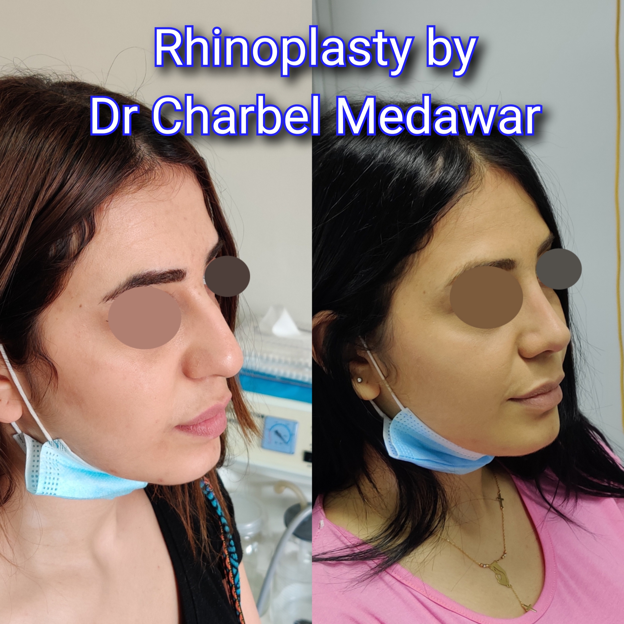 #rhinoplasty #nosejob #dr #charbel #medawar #facial #plastic #surgeon #beirut #lebanon #surgery #style #beauty #clinc #dubai #middle #east