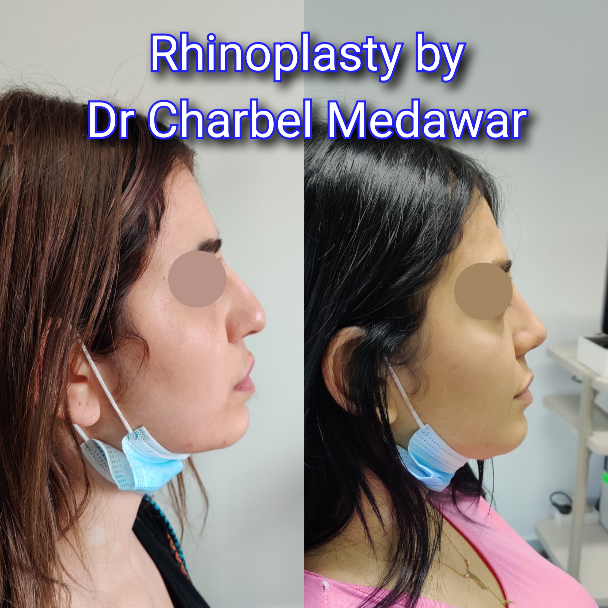 #rhinoplasty #nosejob #dr #charbel #medawar #facial #plastic #surgeon #beirut #lebanon #surgery #style #beauty #clinc #dubai #middle #east