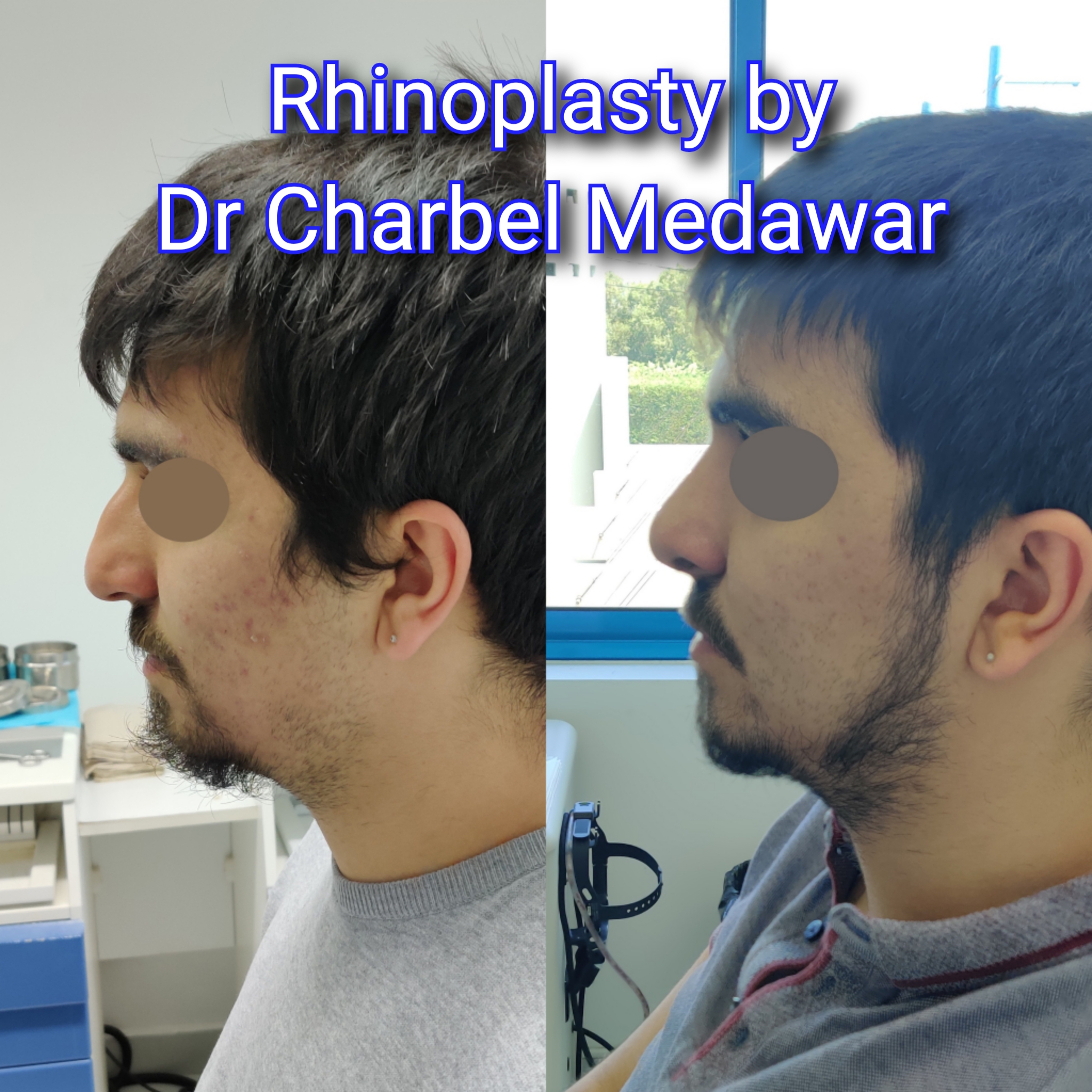 #rhinoplasty #nosejob #dr #charbel #medawar #facial #plastic #surgeon #beirut #lebanon #surgery #style #beauty #clinc #dubai #middle #east