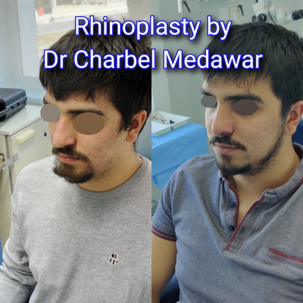 #rhinoplasty #nosejob #dr #charbel #medawar #facial #plastic #surgeon #beirut #lebanon #surgery #style #beauty #clinc #dubai #middle #east