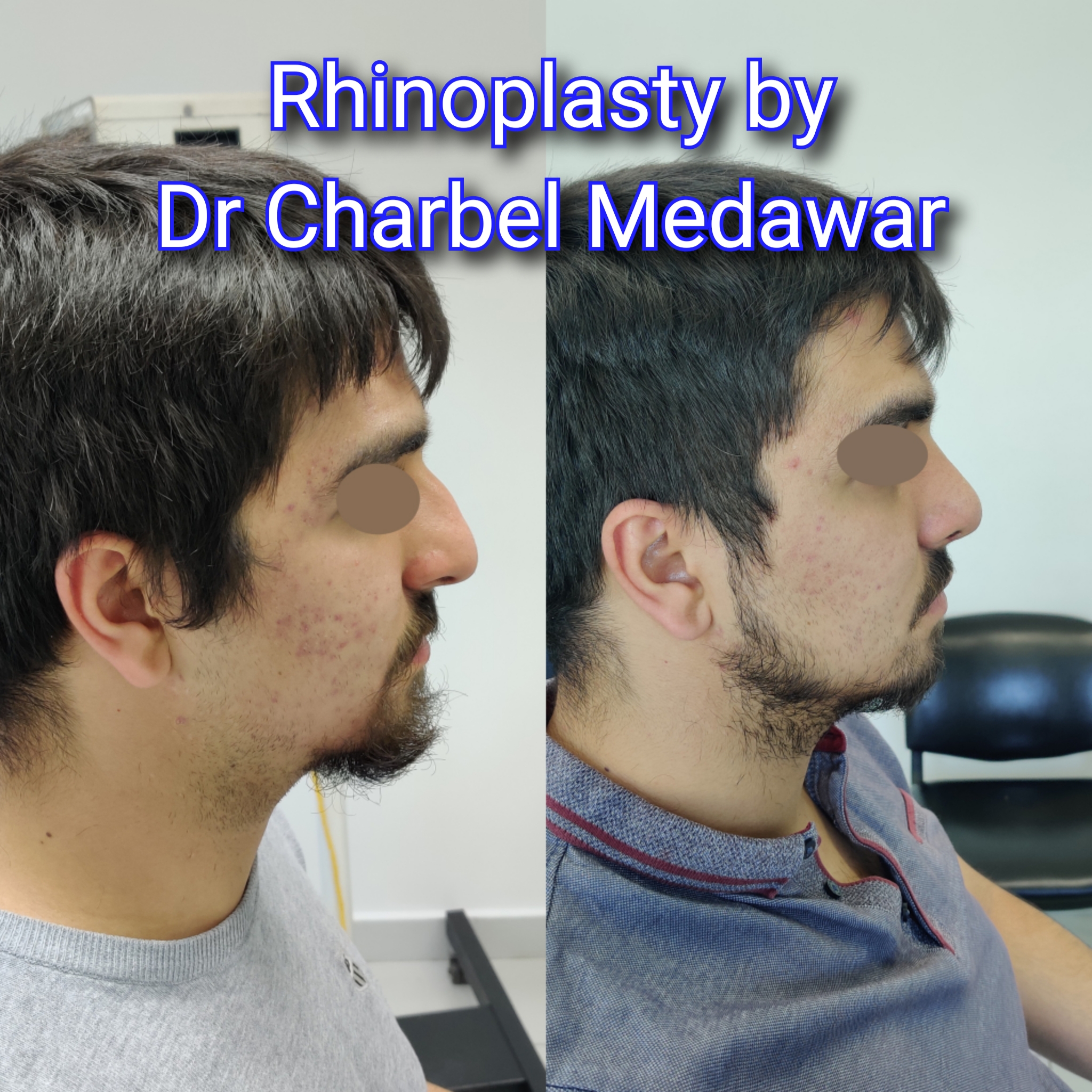 #rhinoplasty #nosejob #dr #charbel #medawar #facial #plastic #surgeon #beirut #lebanon #surgery #style #beauty #clinc #dubai #middle #east