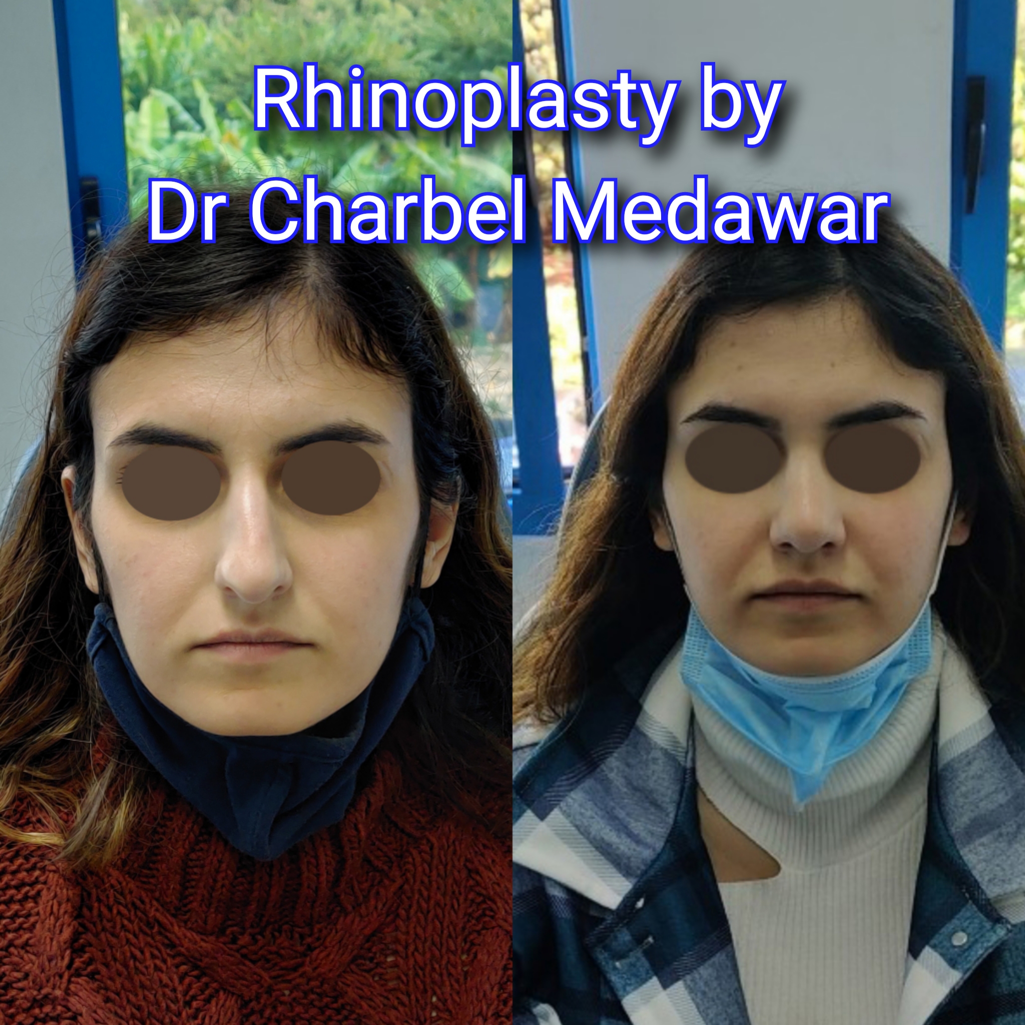 #rhinoplasty #nosejob #dr #charbel #medawar #facial #plastic #surgeon #beirut #lebanon #surgery #style #beauty #clinc #dubai #middle #east