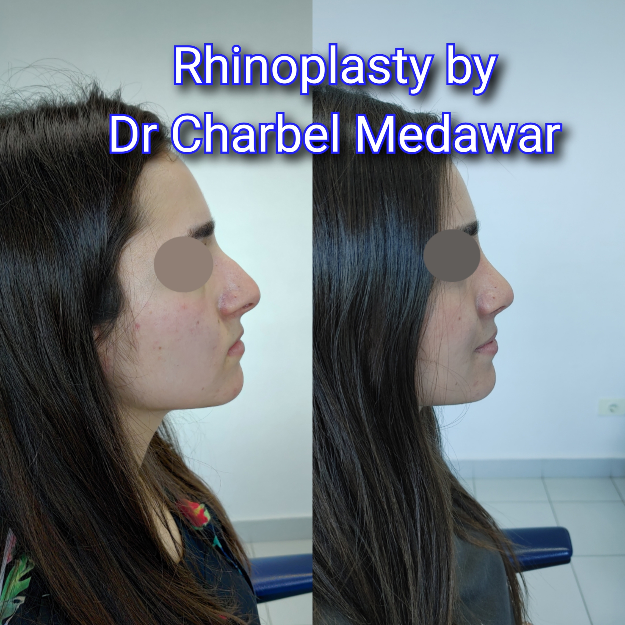 #rhinoplasty #nosejob #dr #charbel #medawar #facial #plastic #surgeon #beirut #lebanon #surgery #style #beauty #clinc #dubai #middle #east