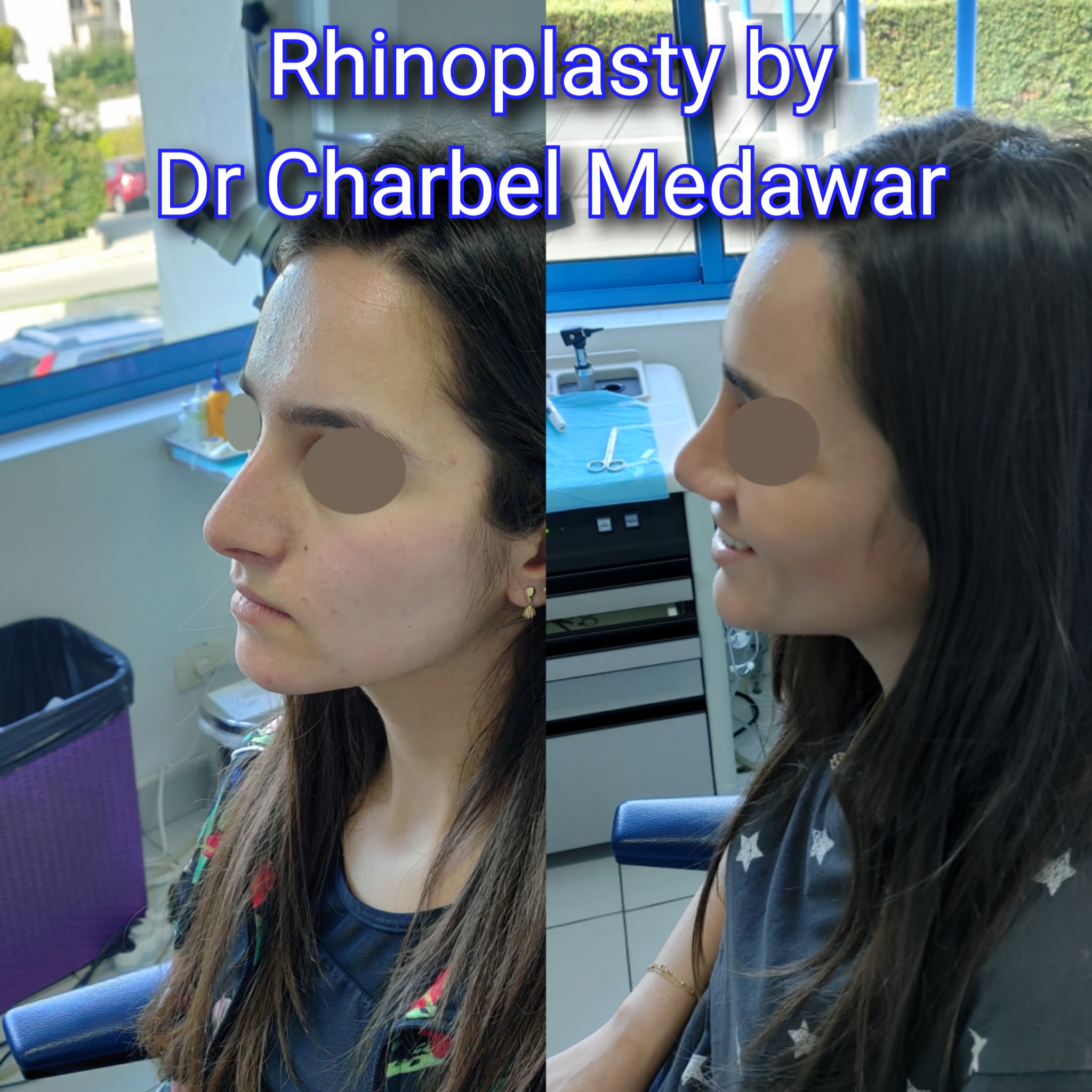 #rhinoplasty #nosejob #dr #charbel #medawar #facial #plastic #surgeon #beirut #lebanon #surgery #style #beauty #clinc #dubai #middle #east