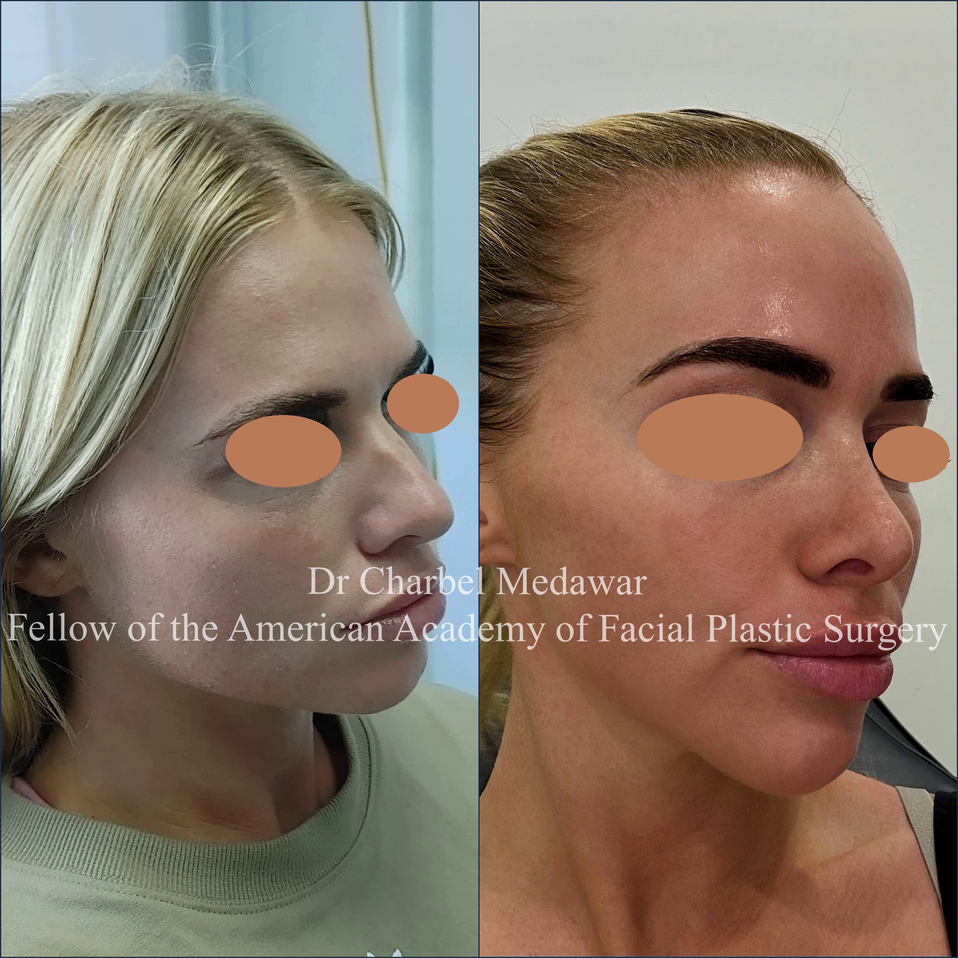 #rhinoplasty #nosejob #dr #charbel #medawar #facial #plastic #surgeon #beirut #lebanon #surgery #style #beauty #clinc #dubai #middle #east