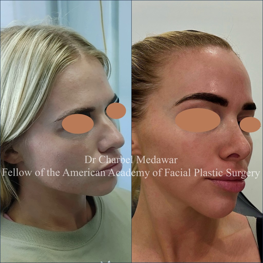 #rhinoplasty #nosejob #dr #charbel #medawar #facial #plastic #surgeon #beirut #lebanon #surgery #style #beauty #clinc #dubai #middle #east