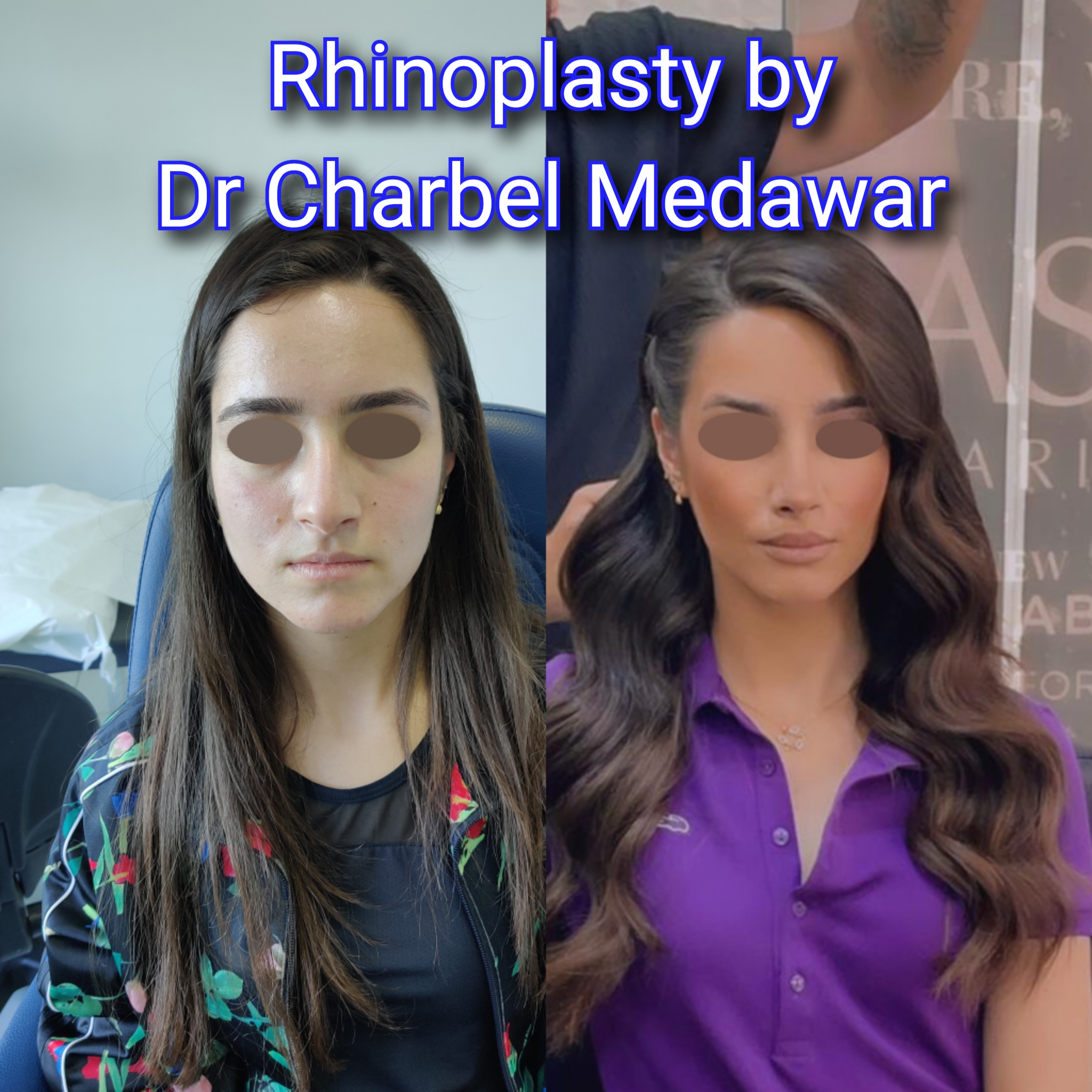 #rhinoplasty #nosejob #dr #charbel #medawar #facial #plastic #surgeon #beirut #lebanon #surgery #style #beauty #clinc #dubai #middle #east