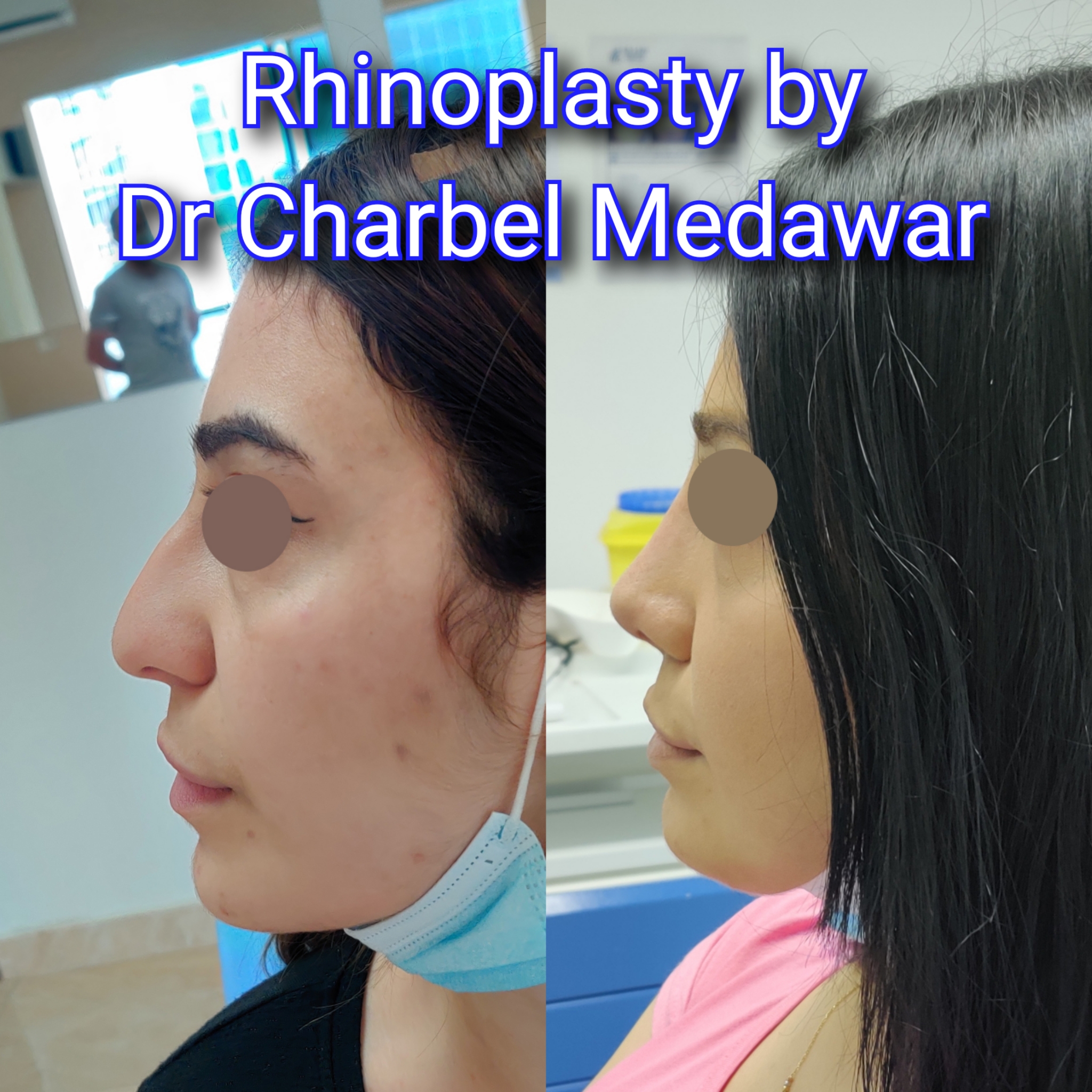 #rhinoplasty #nosejob #dr #charbel #medawar #facial #plastic #surgeon #beirut #lebanon #surgery #style #beauty #clinc #dubai #middle #east