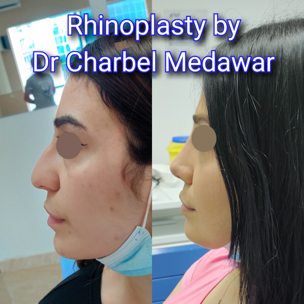 #rhinoplasty #nosejob #dr #charbel #medawar #facial #plastic #surgeon #beirut #lebanon #surgery #style #beauty #clinc #dubai #middle #east