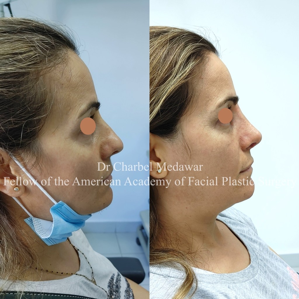 #rhinoplasty #nosejob #dr #charbel #medawar #facial #plastic #surgeon #beirut #lebanon #surgery #style #beauty #clinc #dubai #middle #east