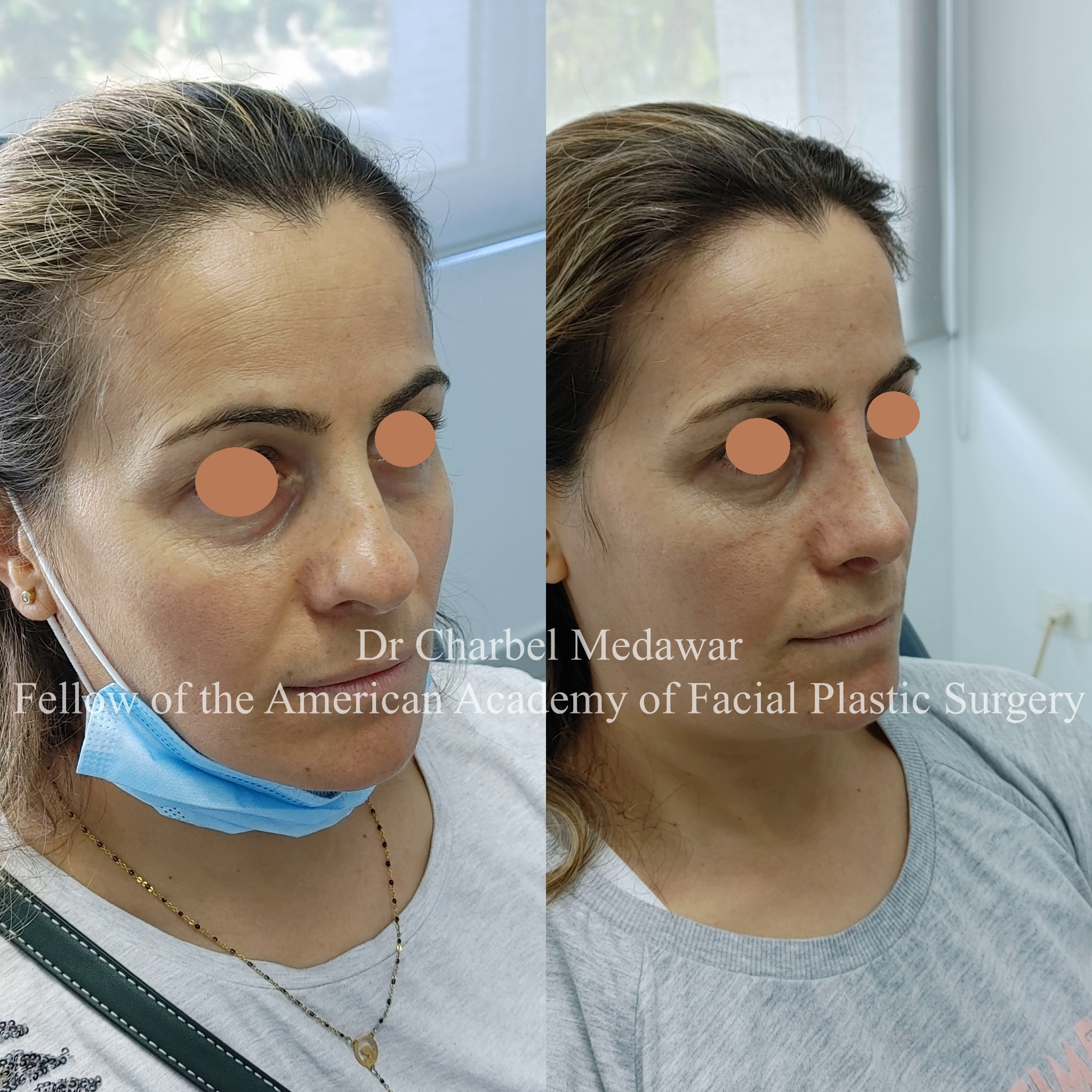 #rhinoplasty #nosejob #dr #charbel #medawar #facial #plastic #surgeon #beirut #lebanon #surgery #style #beauty #clinc #dubai #middle #east