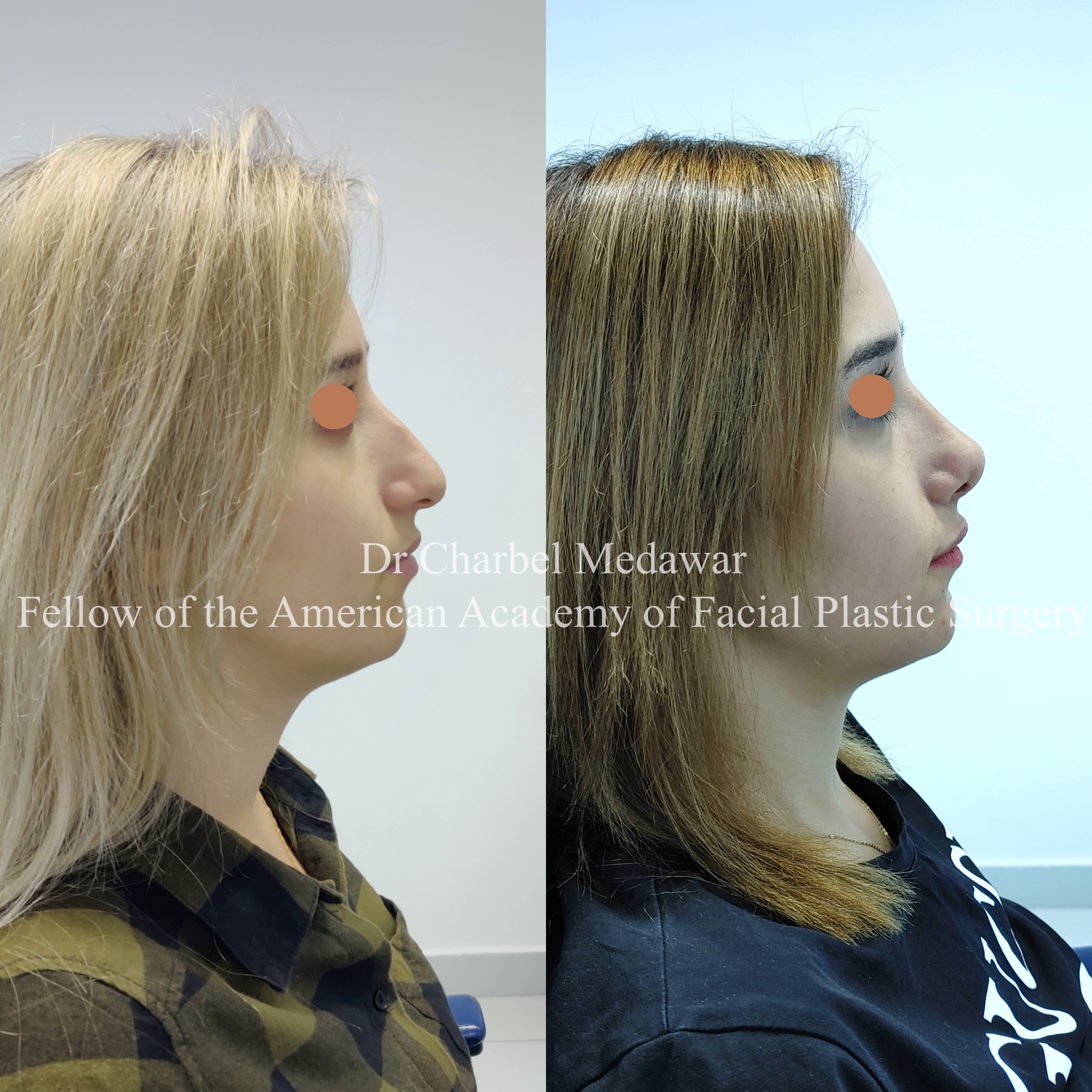#rhinoplasty #nosejob #dr #charbel #medawar #facial #plastic #surgeon #beirut #lebanon #surgery #style #beauty #clinc #dubai #middle #east