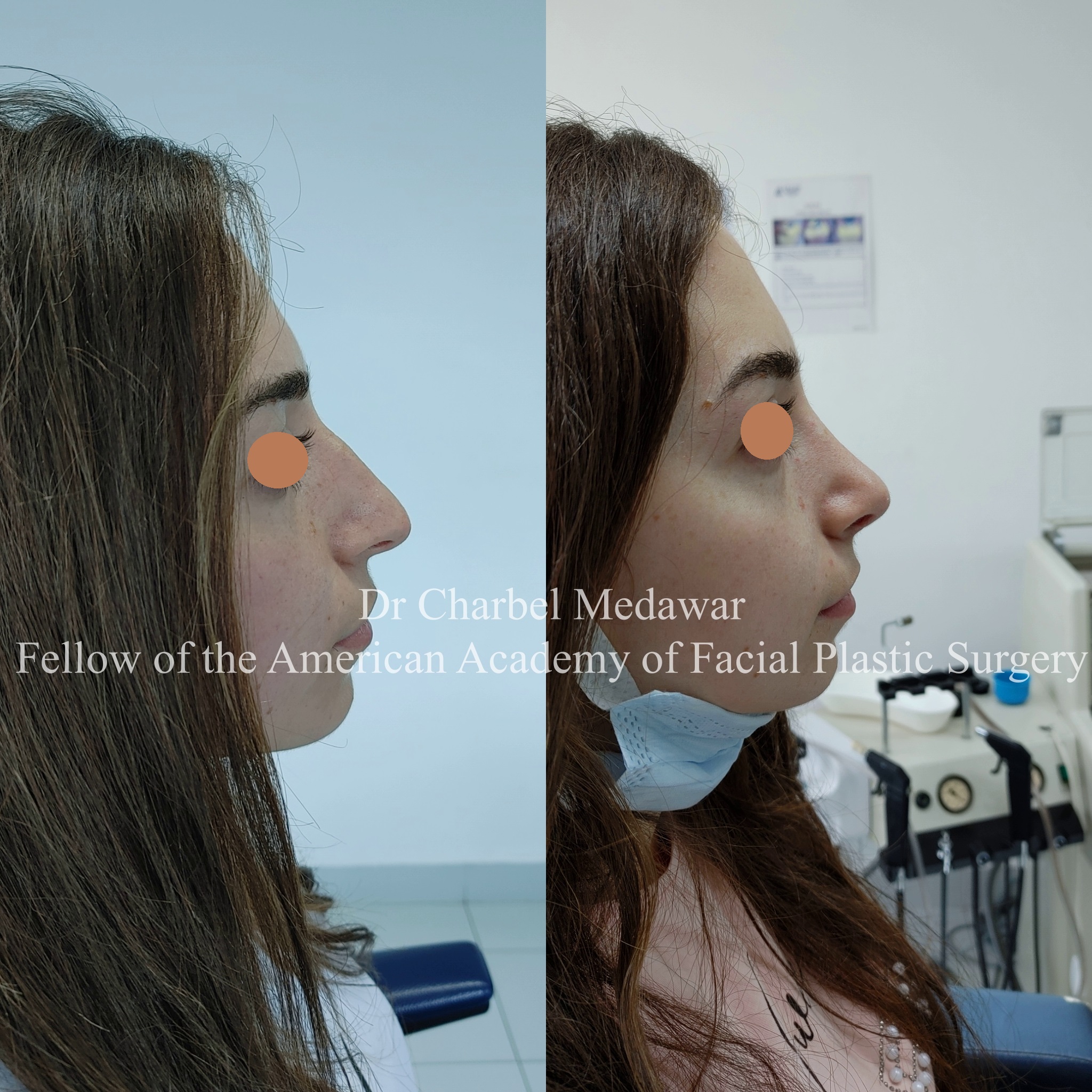#rhinoplasty #nosejob #dr #charbel #medawar #facial #plastic #surgeon #beirut #lebanon #surgery #style #beauty #clinc #dubai #middle #east