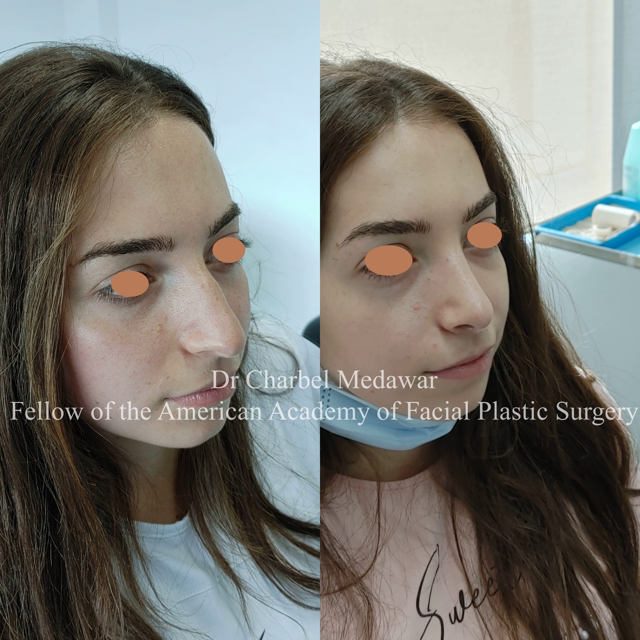 #rhinoplasty #nosejob #dr #charbel #medawar #facial #plastic #surgeon #beirut #lebanon #surgery #style #beauty #clinc #dubai #middle #east