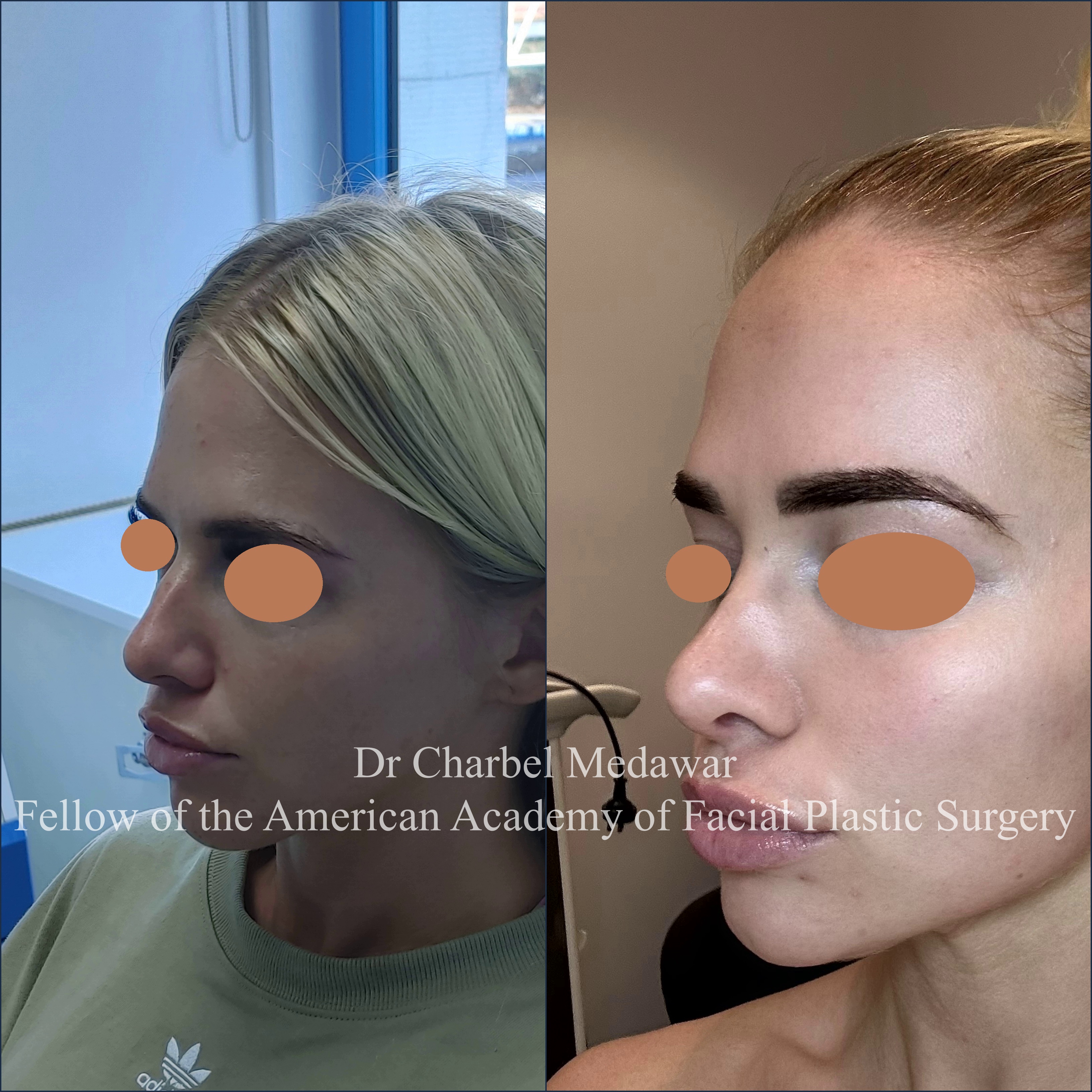 #rhinoplasty #nosejob #dr #charbel #medawar #facial #plastic #surgeon #beirut #lebanon #surgery #style #beauty #clinc #dubai #middle #east