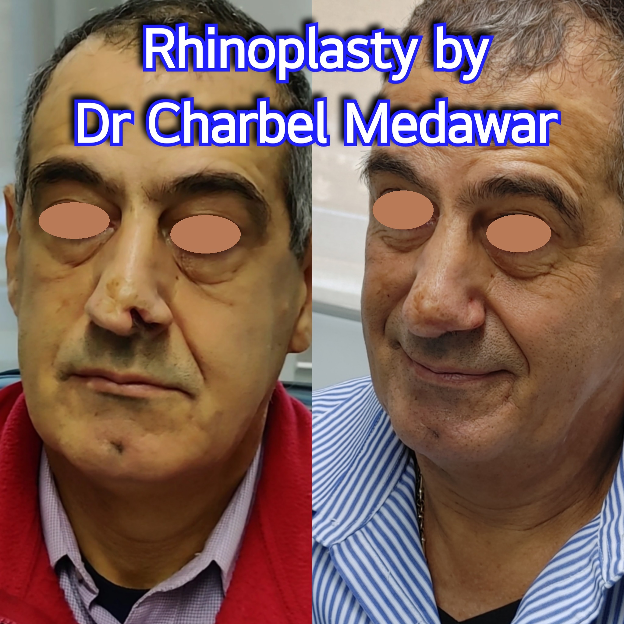 #rhinoplasty #nosejob #dr #charbel #medawar #facial #plastic #surgeon #beirut #lebanon #surgery #style #beauty #clinc #dubai #middle #east