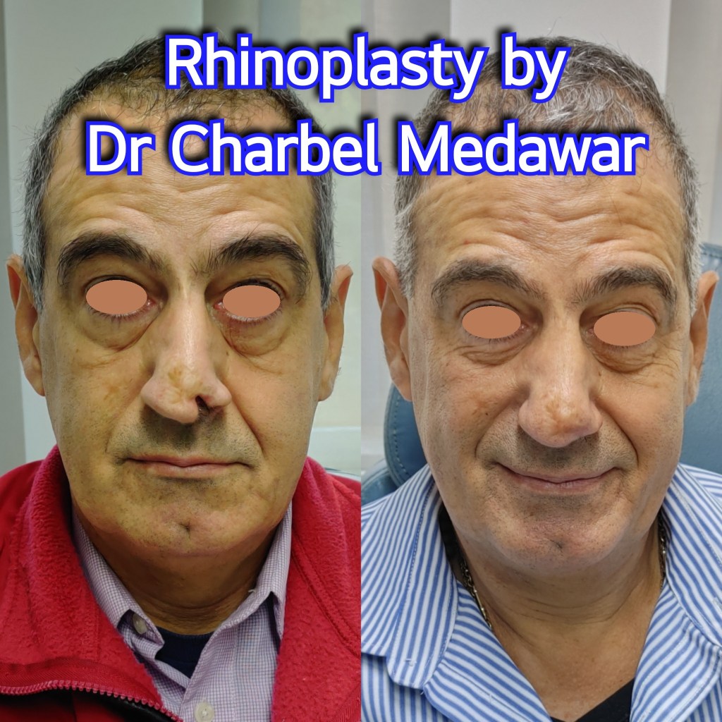 #rhinoplasty #nosejob #dr #charbel #medawar #facial #plastic #surgeon #beirut #lebanon #surgery #style #beauty #clinc #dubai #middle #east