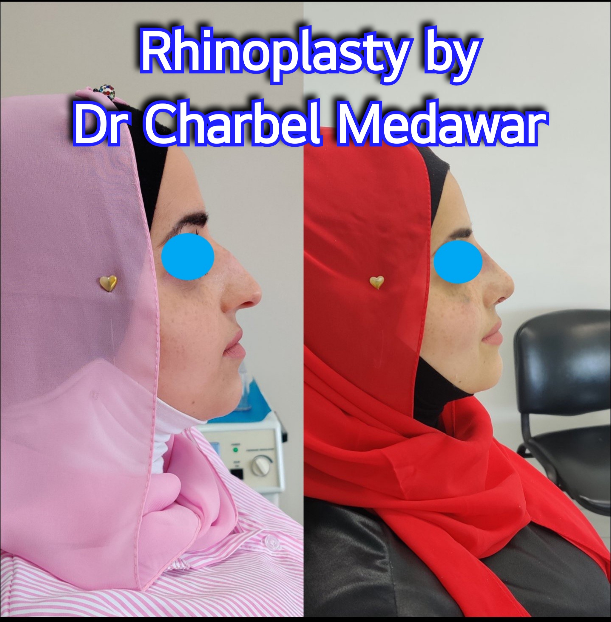 #rhinoplasty #nosejob #dr #charbel #medawar #facial #plastic #surgeon #beirut #lebanon #surgery #style #beauty #clinc #dubai #middle #east