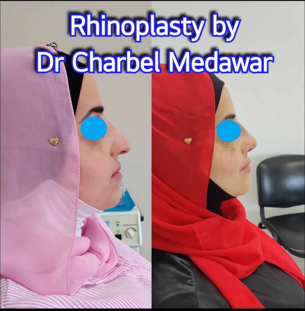 #rhinoplasty #nosejob #dr #charbel #medawar #facial #plastic #surgeon #beirut #lebanon #surgery #style #beauty #clinc #dubai #middle #east