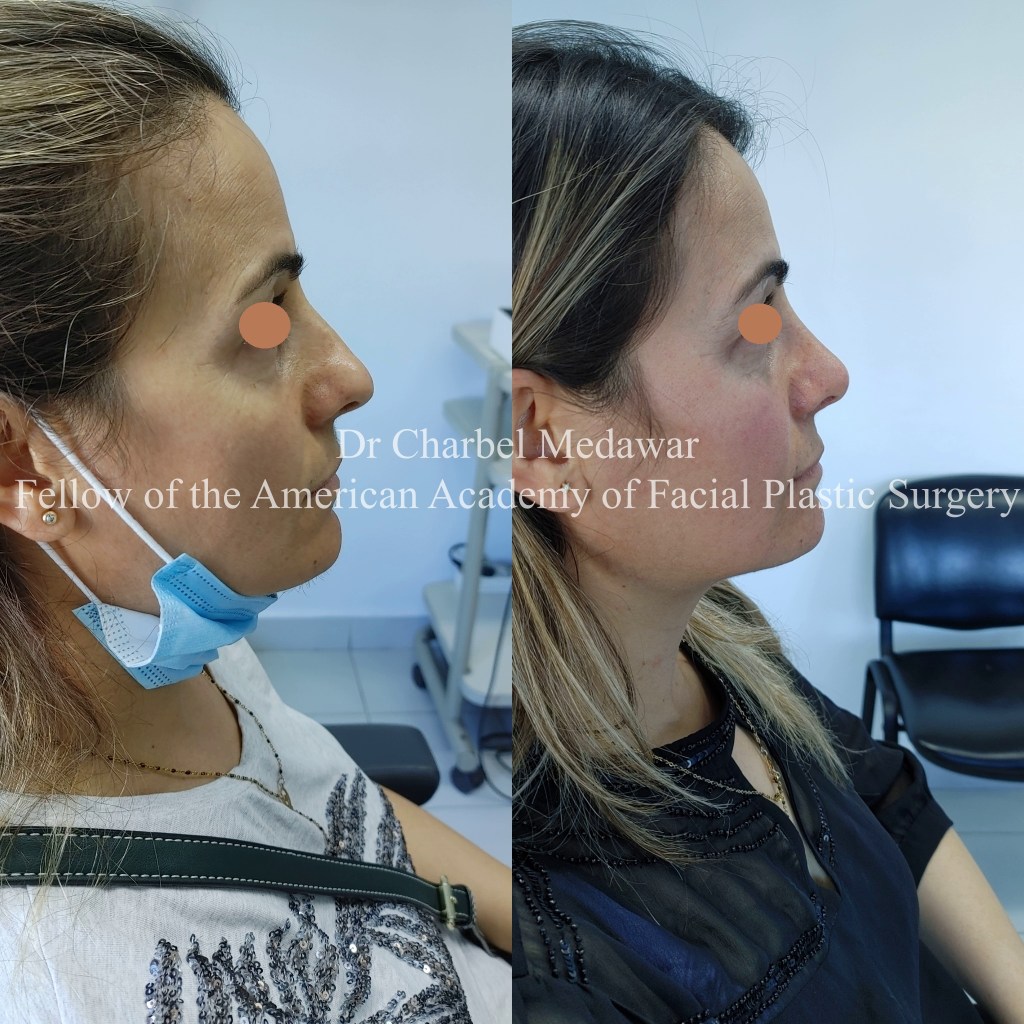 #rhinoplasty #nosejob #dr #charbel #medawar #facial #plastic #surgeon #beirut #lebanon #surgery #style #beauty #clinc #dubai #middle #east