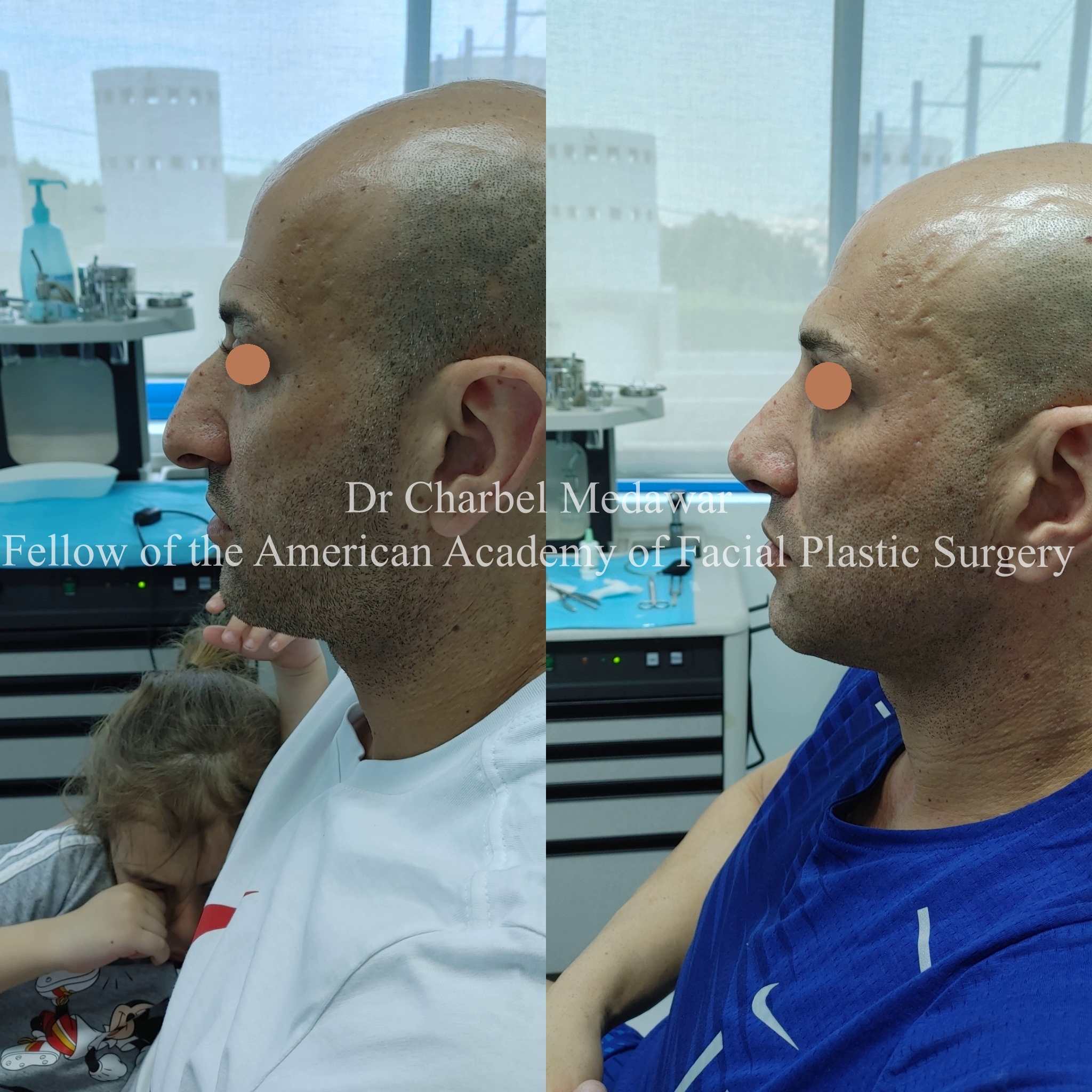 #rhinoplasty #nosejob #dr #charbel #medawar #facial #plastic #surgeon #beirut #lebanon #surgery #style #beauty #clinc #dubai #middle #east