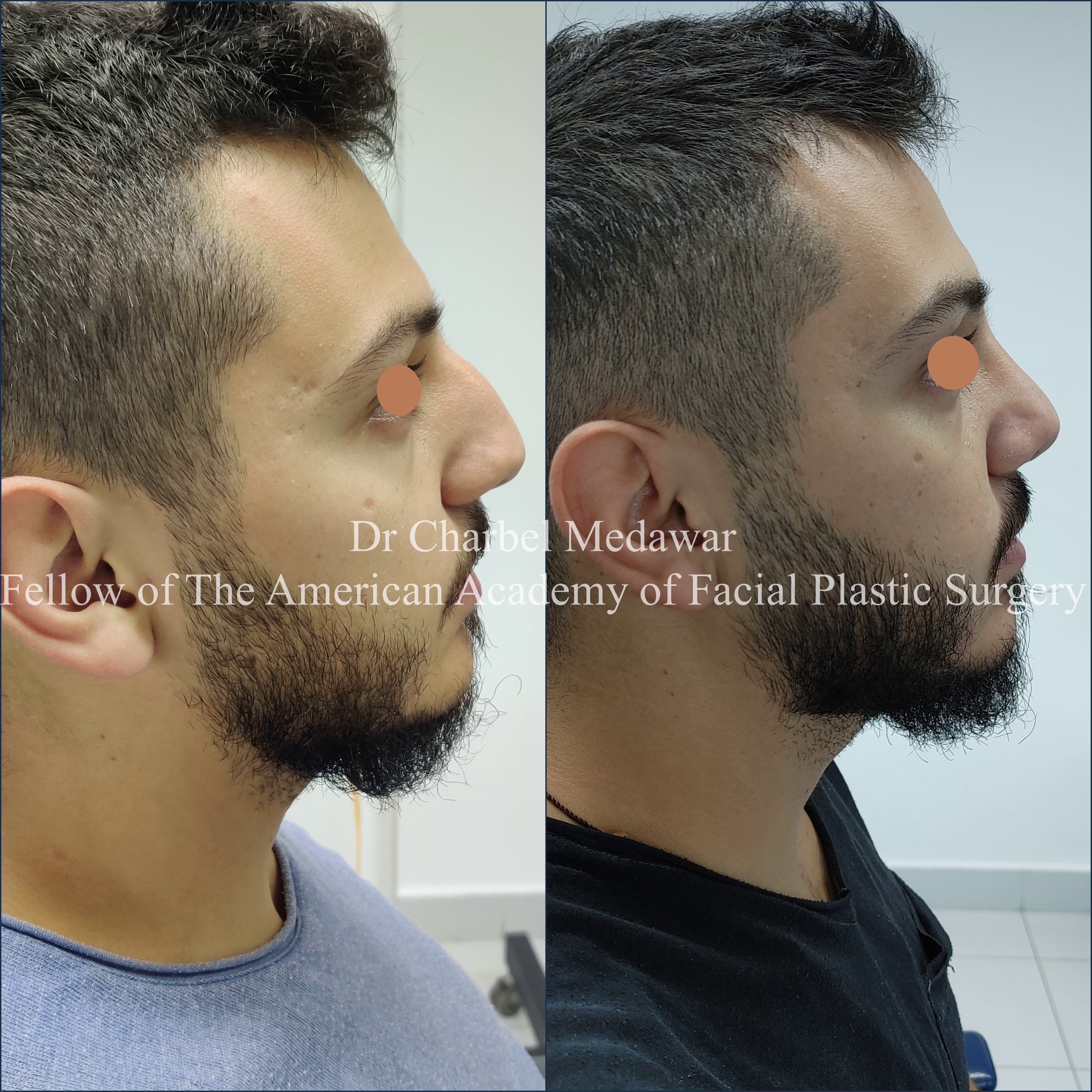 #rhinoplasty #nosejob #dr #charbel #medawar #facial #plastic #surgeon #beirut #lebanon #surgery #style #beauty #clinc #dubai #middle #east