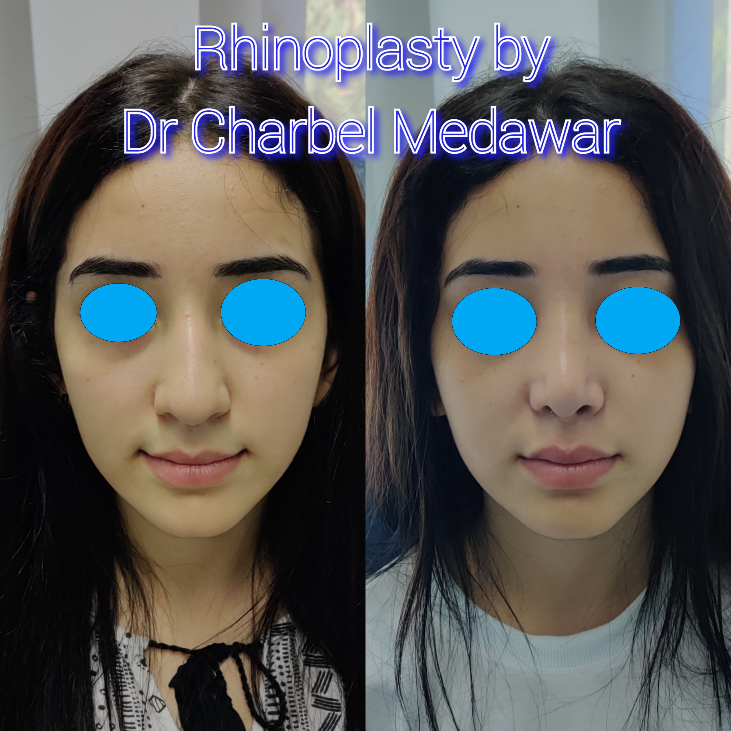 #rhinoplasty #nosejob #dr #charbel #medawar #facial #plastic #surgeon #beirut #lebanon #surgery #style #beauty #clinc #dubai #middle #east