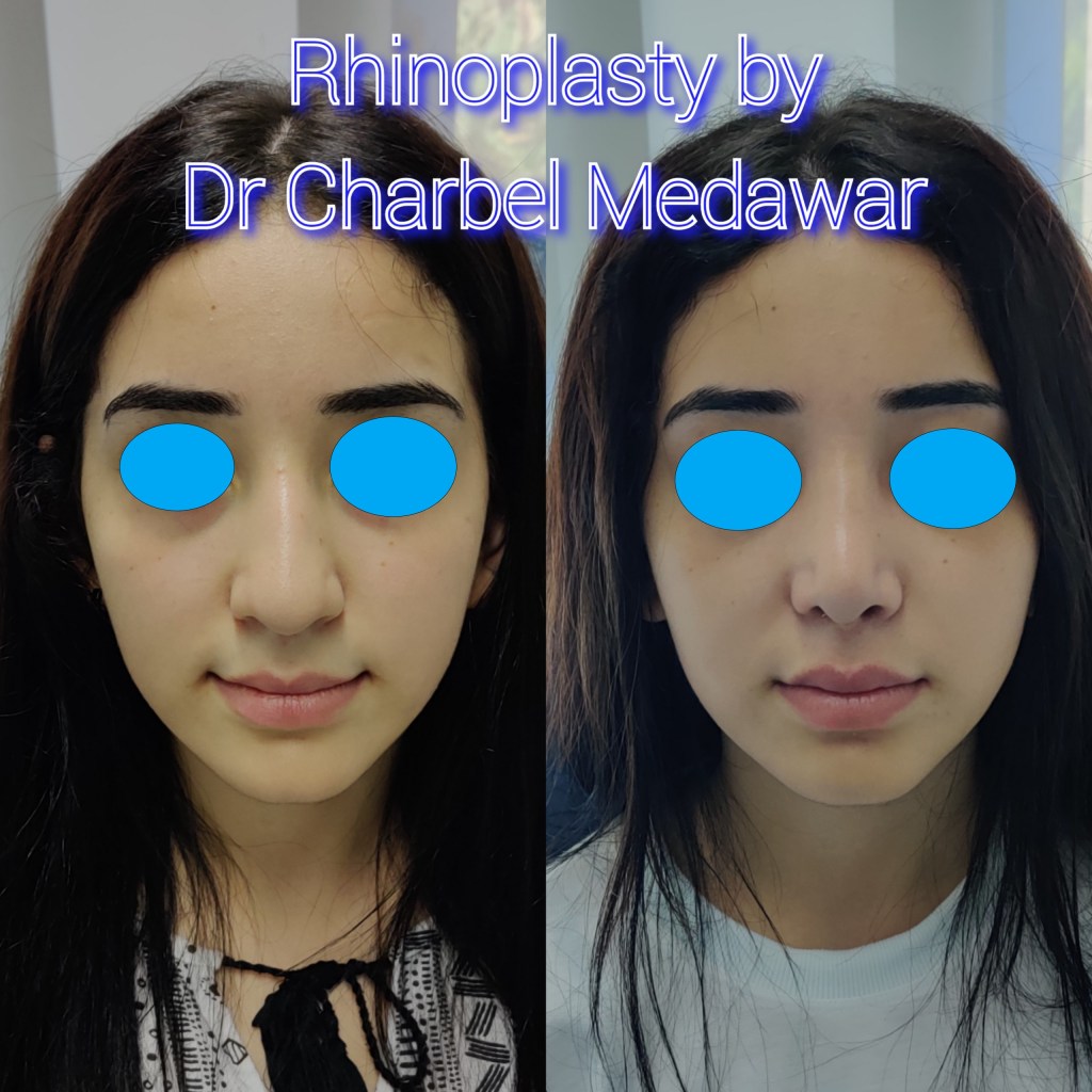 #rhinoplasty #nosejob #dr #charbel #medawar #facial #plastic #surgeon #beirut #lebanon #surgery #style #beauty #clinc #dubai #middle #east