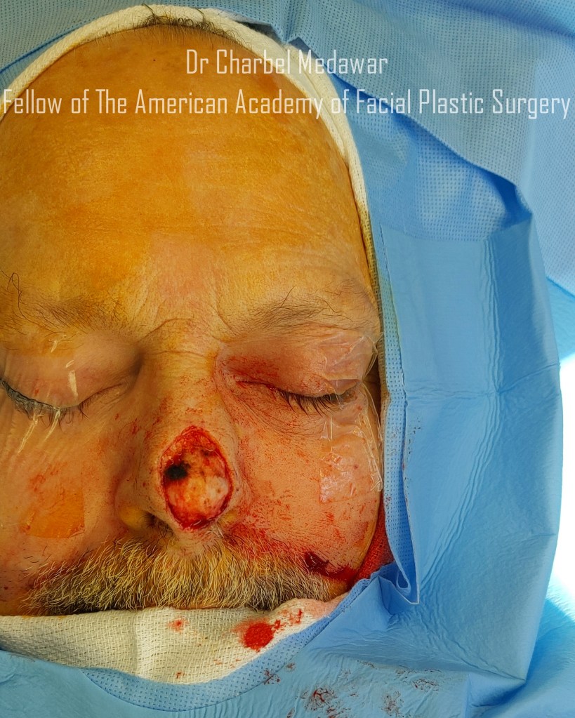 skin cancer removal surgery beirut lebanon facial plastic surgeon dr charbel medawar top middle east