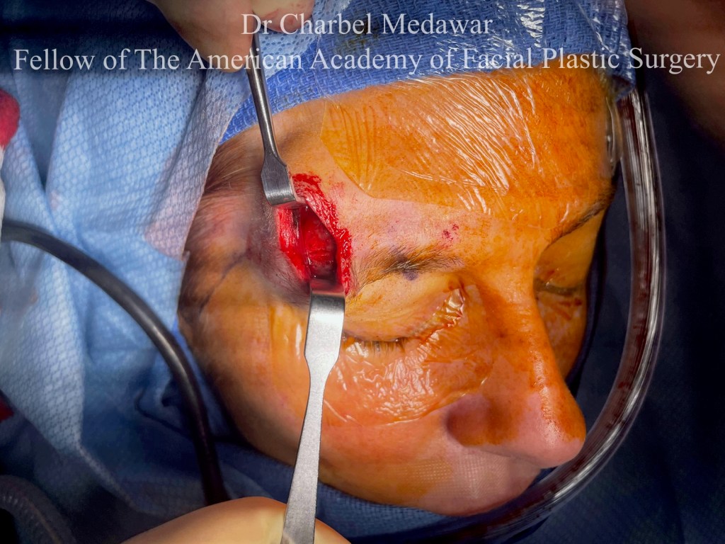 surgery reconstructive skin case facial cosmetic surgery facial plastic surgeon dr charbel medawar style beauty clinic beirut lebanon dubai top surgeon